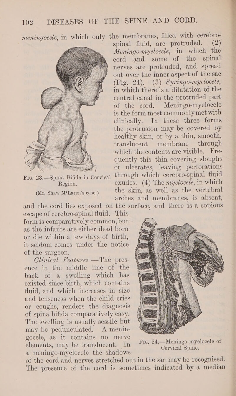 meningocele, in which only the membranes, filled with cerebro- | spinal fluid, are protruded. (2) Meningo-myelocele, in which the cord and some of the spinal nerves are protruded, and spread out over the inner aspect of the sac (Fig. 24). (3) Syringo-myelocele, in which there is a dilatation of the central canal in the protruded part of the cord. Meningo-myelocele is the form most commonly met with clinically. In these three forms the protrusion may be covered by healthy skin, or by a thin, smooth, translucent membrane through which the contents are visible. Fre- quently this thin covering sloughs or ulcerates, leaving perforations ervical through which cerebro-spinal fluid Region. exudes. (4) The myelocele, in which Ctercnawirtinren’s case.) the skin, as well as the vertebral arches and membranes, is absent, and the cord lies exposed on the surface, and there is a copious escape of cerebro-spinal fluid. This form is comparatively common, but as the infants are either dead born or die within a few days of birth, it seldom comes under the notice of the surgeon. Clinical Features.—The pres- ence in the middle line of the back of a swelling which has existed since birth, which contains fluid, and which increases in size and tenseness when the child cries or coughs, renders the diagnosis of spina bifida comparatively easy. The swelling is usually sessile but may be pedunculated. A menin- gocele, aS it contains no nerve elements, may be translucent. In! ie Mere O MES ef ; ervical Spine. a meningo-myelocele the shadows | of the cord and nerves stretched out in the sac may be recognised. The presence of the cord is sometimes indicated by a median