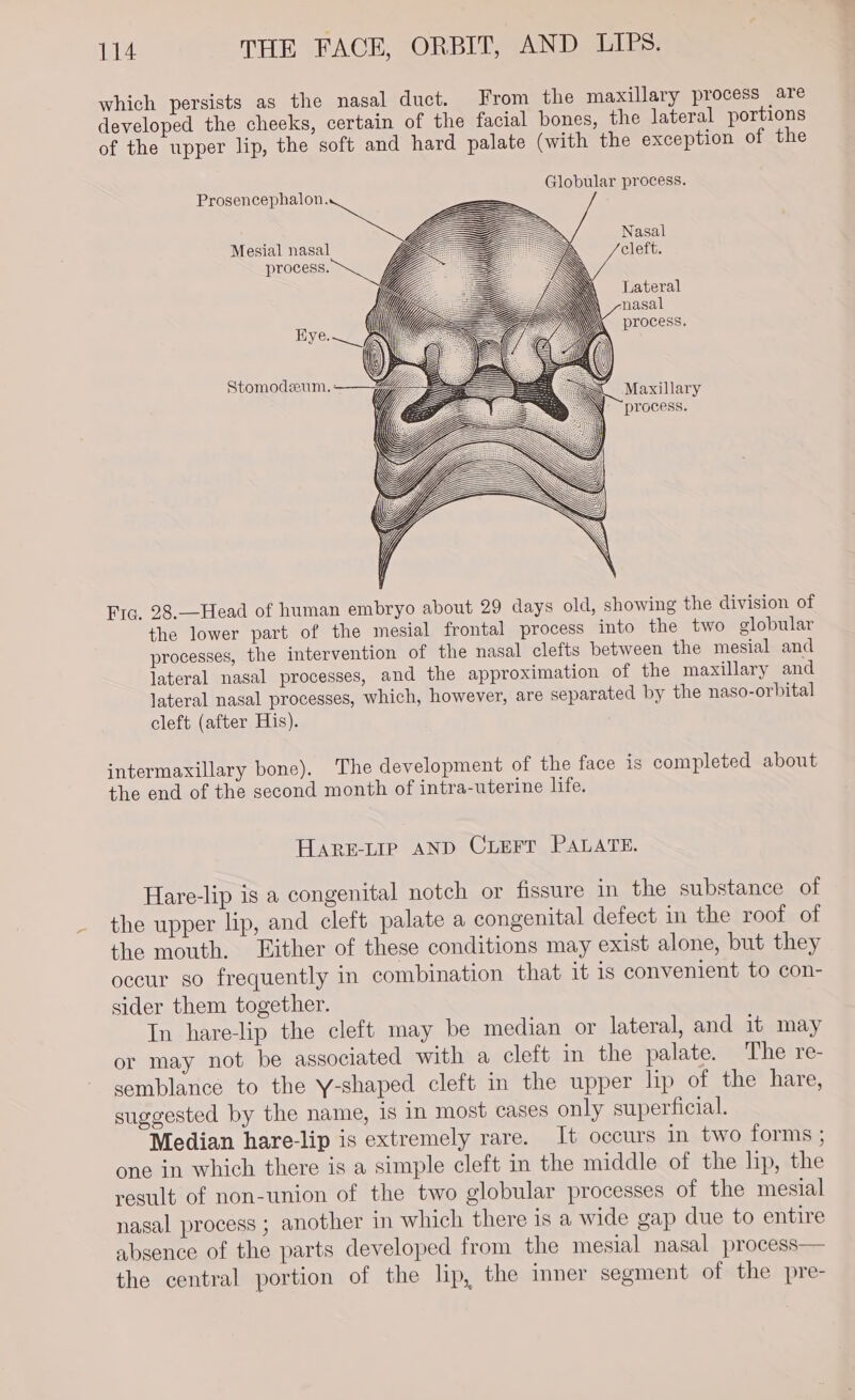 which persists as the nasal duct. From the maxillary process are developed the cheeks, certain of the facial bones, the lateral portions of the upper lip, the soft and hard palate (with the exception of the Globular process. Prosencephalon. Nasal Mesial nasal cleft. process. Lateral nasal process. Maxillary process. Y U, Wy Fic. 28.—Head of human embryo about 29 days old, showing the division of the lower part of the mesial frontal process into the two globular processes, the intervention of the nasal clefts between the mesial and lateral nasal processes, and the approximation of the maxillary and lateral nasal processes, which, however, are separated by the naso-orbital cleft (after His). intermaxillary bone). The development of the face is completed about the end of the second month of intra-uterine life. HARE-LIP AND CLEFT PALATE. Hare-lip is a congenital notch or fissure in the substance of the upper lip, and cleft palate a congenital defect in the roof of the mouth. Either of these conditions may exist alone, but they occur so frequently in combination that it 1s convenient to con- sider them together. In hare-lip the cleft may be median or lateral, and it may or may not be associated with a cleft in the palate. The re- semblance to the Y-shaped cleft in the upper lip of the hare, suggested by the name, is in most cases only superficial. Median hare-lip is extremely rare. It occurs in two forms ; one in which there is a simple cleft in the middle of the lip, the result of non-union of the two globular processes of the mesial nasal process ; another in which there is a wide gap due to entire absence of the parts developed from the mesial nasal process— the central portion of the lip, the inner segment of the pre-