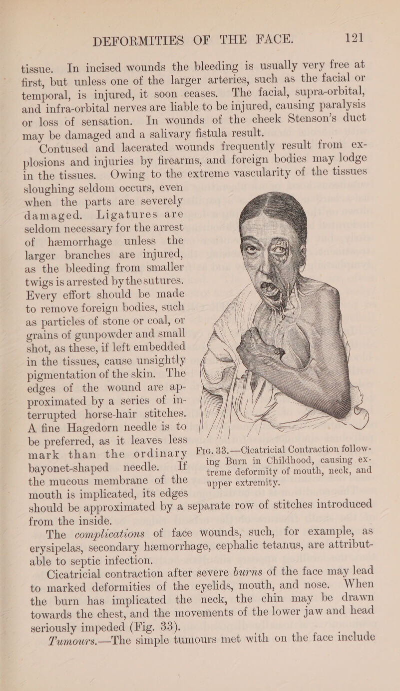 tissue. In incised wounds the bleeding is usually very free at first, but unless one of the larger arteries, such as the facial or temporal, is injured, it soon ceases. The facial, supra-orbital, and infra-orbital nerves are liable to be injured, causing paralysis or loss of sensation. In wounds of the cheek Stenson’s duct may be damaged and a salivary fistula result. | Contused and lacerated wounds frequently result from ex- plosions and injuries by firearms, and foreign bodies may lodge in the tissues. Owing to the extreme vascularity of the tissues sloughing seldom occurs, even when the parts are severely damaged. lLigatures are seldom necessary for the arrest of hemorrhage unless the larger branches are injured, as the bleeding from smaller twigs is arrested by the sutures. Every effort should be made to remove foreign bodies, such as particles of stone or coal, or grains of gunpowder and small shot, as these, if left embedded in the tissues, cause unsightly pigmentation of the skin. The edges of the wound are ap- proximated by a series of in- terrupted horse-hair stitches. A fine Hagedorn needle is to be preferred, as it leaves less mark than the ordinary Fic. 33.—Cicatricial Contraction follow- - ing Burn in Childhood, causing ex- eaten arenas ec f “ teas deformity of mouth, cae and upper extremity. mouth is implicated, its edges should be approximated by a separate row of stitches introduced from the inside. The complications of face wounds, such, for example, as erysipelas, secondary hemorrhage, cephalic tetanus, are attribut- able to septic infection. Cicatricial contraction after severe burns of the face may lead to marked deformities of the eyelids, mouth, and nose. When the burn has implicated the neck, the chin may be drawn towards the chest, and the movements of the lower jaw and head seriously impeded (Fig. 33). Tumours.—The simple tumours met with on the face include