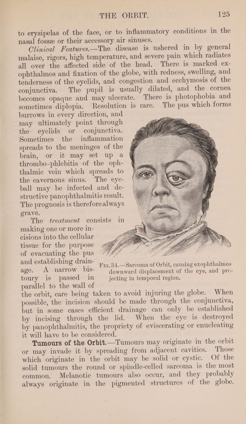 to erysipelas of the face, or to inflammatory conditions in the nasal fossee or their accessory air sinuses. Clinical Features.—The disease is ushered in by general malaise, rigors, high temperature, and severe pain which radiates all over the affected side of the head. There is marked ex- ophthalmos and fixation of the globe, with redness, swelling, and tenderness of the eyelids, and congestion and ecchymosis of the conjunctiva. The pupil is usually dilated, and the cornea becomes opaque and may ulcerate. There is photophobia and sometimes diplopia. Resolution is rare. The pus which forms burrows in every direction, and may ultimately point through the eyelids or conjunctiva. Sometimes the inflammation spreads to the meninges of the brain, or it may set up a thrombo-phlebitis of the oph- thalmic vein which spreads to the cavernous sinus. The eye- ball may be infected and de- structive panophthalmitis result. The prognosis is thereforealways orave. The treatment consists in making one or more in- cisions into the cellular tissue for the purpose of evacuating the pus and establishing cram ~ Fiq¢,34.—Sarcoma of Orbit, causing exophthalmos oo A paseo bis- downward displacement of the eye, and pro- toury 1s passed mM jecting in temporal region. parallel to the wall of the orbit, care being taken to avoid injuring the globe. When possible, the incision should be made through the conjunctiva, but in some cases efficient drainage can only be established by incising through the lid. When the eye is destroyed by panophthalmitis, the propriety of eviscerating or enucleating it will have to be considered. Tumours of the Orbit.—Tumours may originate in the orbit or may invade it by spreading from adjacent cavities. Those which originate in the orbit may be solid or cystic. Of the solid tumours the round or spindle-celled sarcoma is the most common. Melanotic tumours also occur, and they probably always originate in the pigmented structures of the globe.