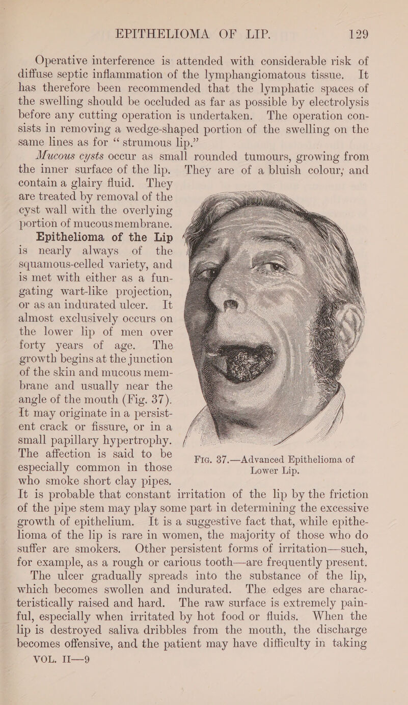 Operative interference is attended with considerable risk of diffuse septic inflammation of the lymphangiomatous tissue. It has therefore been recommended that the lymphatic spaces of the swelling should be occluded as far as possible by electrolysis before any cutting operation is undertaken. The operation con- sists in removing a wedge-shaped portion of the swelling on the same lines as for “ strumous lip.” Mucous cysts occur as small rounded tumours, growing from the inner surface of the lip. They are of a bluish colour; and contain a glairy fluid. They are treated by removal of the eyst wall with the overlying portion of mucous membrane. Epithelioma of the Lip is nearly always of the squamous-celled variety, and is met with either as a fun- gating wart-like projection, or as an indurated ulcer. It almost exclusively occurs on the lower lp of men over forty years of age. The growth begins at the junction of the skin and mucous mem- brane and usually near the angle of the mouth (Fig. 37). It may originate in a persist- ent crack or fissure, or in a small papillary hypertrophy. / | ; The affection is said to be Fia. 37.—Advanced Epithelioma of especially common in those Lower Lip. who smoke short clay pipes. It is probable that constant irritation of the lip by the friction of the pipe stem may play some part in determining the excessive growth of epithelium. It is a suggestive fact that, while epithe- homa of the lip is rare in women, the majority of those who do suffer are smokers. Other persistent forms of irritation—such, for example, as a rough or carious tooth—are frequently present. The ulcer gradually spreads into the substance of the lip, which becomes swollen and indurated. The edges are charac- teristically raised and hard. The raw surface is extremely pain- ful, especially when irritated by hot food or fluids. When the lip is destroyed saliva dribbles from the mouth, the discharge becomes offensive, and the patient may have difficulty in taking VOL Ti