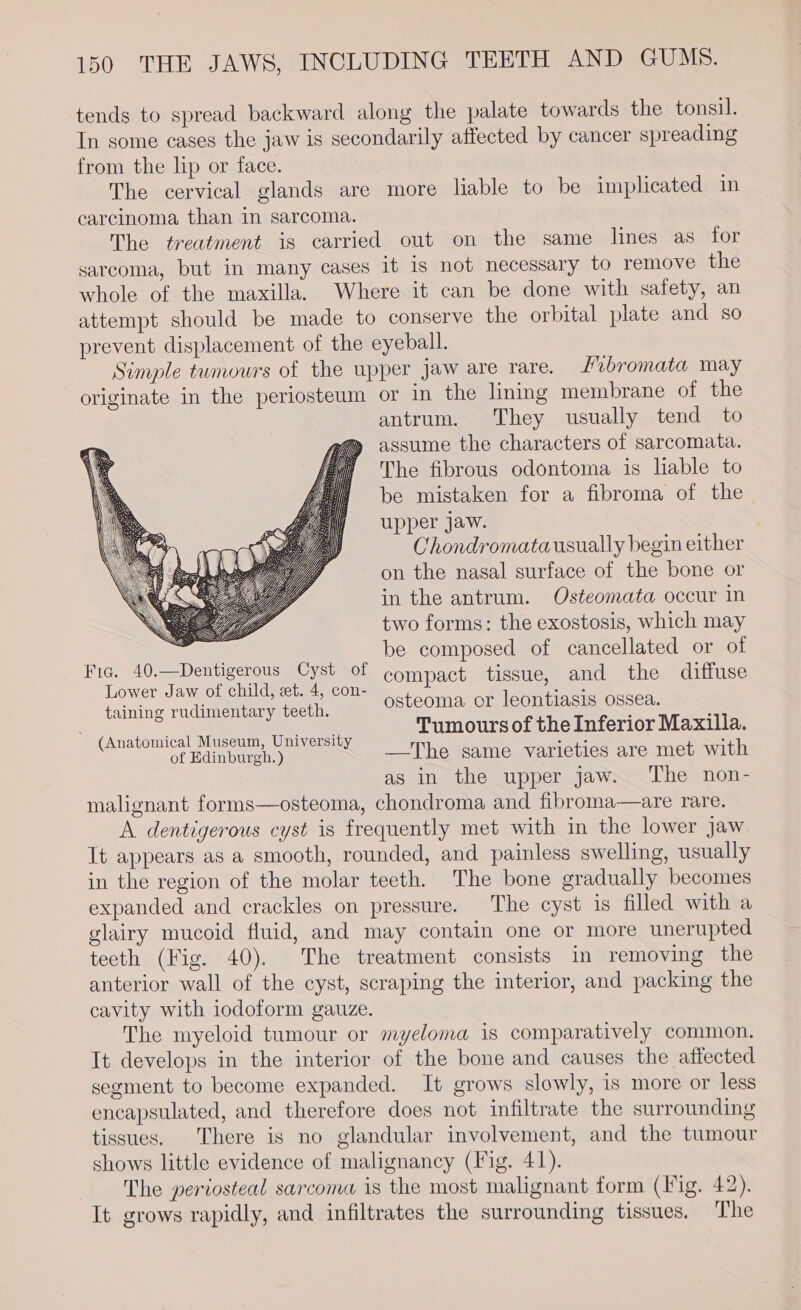 tends to spread backward along the palate towards the tonsil. In some cases the jaw is secondarily affected by cancer spreading from the lip or face. The cervical glands are more liable to be implicated in carcinoma than in sarcoma. The treatment is carried out on the same lines as for sarcoma, but in many cases it 1s not necessary to remove the whole of the maxilla. Where it can be done with safety, an attempt should be made to conserve the orbital plate and so prevent displacement of the eyeball. Simple tumours of the upper jaw are rare. Lvbromata may originate in the periosteum or in the lining membrane of the antrum. They usually tend to assume the characters of sarcomata. The fibrous odontoma is liable to be mistaken for a fibroma of the upper jaw. Chondromatausually begin either on the nasal surface of the bone or in the antrum. Osteomata occur in two forms: the exostosis, which may be composed of cancellated or of compact tissue, and the diffuse osteoma or leontiasis ossea. . duos Tumours of the Inferior Maxilla. (Anatomical Museum, University ee . of Edinburgh.) —The same varieties are met with as in the upper jaw. The non- malignant forms—osteoma, chondroma and fibroma—are rare. A dentigerous cyst is frequently met with in the lower jaw It appears as a smooth, rounded, and painless swelling, usually in the region of the molar teeth. The bone gradually becomes expanded and crackles on pressure. The cyst is filled with a glairy mucoid fluid, and may contain one or more unerupted teeth (Fig. 40). The treatment consists in removing the anterior wall of the cyst, scraping the interior, and packing the cavity with iodoform gauze. The myeloid tumour or myeloma is comparatively common. It develops in the interior of the bone and causes the affected segment to become expanded. It grows slowly, is more or less encapsulated, and therefore does not infiltrate the surrounding tissues. There is no glandular involvement, and the tumour shows little evidence of malignancy (Fig. 41). The periosteal sarcoma is the most malignant form (Fig. 42). It grows rapidly, and infiltrates the surrounding tissues. The