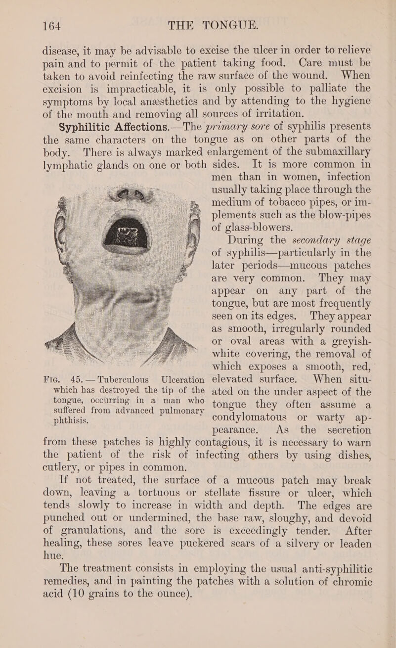 disease, it may be advisable to excise the ulcer in order to relieve pain and to permit of the patient taking food. Care must be taken to avoid reinfecting the raw surface of the wound. When excision is impracticable, it is only possible to palliate the symptoms by local anesthetics and by attending to the hygiene of the mouth and removing all sources of irritation. Syphilitic Affections.—The primary sore of syphilis presents the same characters on the tongue as on other parts of the body. There is always marked enlargement of the submaxillary lymphatic glands on one or both sides. It is more common in men than in women, infection usually taking place through the medium of tobacco pipes, or im- plements such as the blow-pipes of glass-blowers. During the secondary stage of syphilis—particularly in the later periods—mucous patches are very common. They may appear on any part of the tongue, but are most frequently seen on its edges. They appear as smooth, irregularly rounded or oval areas with a greyish- white covering, the removal of ease which exposes a smooth, red, Fie. 45.—Tuberculous Ulceration elevated surface. When situ- which has destroyed the tip of the ated on the under aspect of the tongue, occurring In a man who tongue they often assume a suffered from advanced pulmonary phthisis. condylomatous or warty ap- pearance. As the secretion from these patches is highly contagious, it is necessary to warn the patient of the risk of infecting others by using dishes, cutlery, or pipes in common. If not treated, the surface of a mucous patch may break down, leaving a tortuous or stellate fissure or ulcer, which tends slowly to increase in width and depth. The edges are punched out or undermined, the base raw, sloughy, and devoid of granulations, and the sore is exceedingly tender. After healing, these sores leave puckered scars of a silvery or leaden hue: The treatment consists in employing the usual anti-syphilitic remedies, and in painting the patches with a solution of chromic acid (10 grains to the ounce).