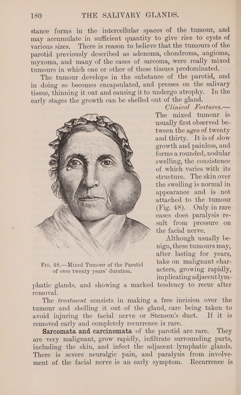 stance forms in the intercellular spaces of the tumour, and may accumulate in sufficient quantity to give rise to cysts of various sizes. There is reason to believe that the tumours of the parotid previously described as adenoma, chondroma, angioma, myxoma, and many of the cases of sarcoma, were really mixed tumours in which one or other of these tissues predominated. The tumour develops in the substance of the parotid, and in doing so becomes encapsulated, and presses on the salivary tissue, thinning it out and causing it to undergo atrophy. In the early stages the growth can be shelled out of the gland. Clinical Features.— The mixed tumour is usually first observed be- tween the ages of twenty and thirty. It is of slow growth and painless, and forms a rounded, nodular swelling, the consistence of which varies with its structure. The skin over the swelling is normal in appearance and is not attached to the tumour (Fig. 48). Only in rare cases does paralysis re- sult from pressure on the facial nerve. Although usually be- nign, these tumours may, : after lasting for years, Fic. 48.—Mixed Tumour of the Parotid take on malignant char- of over twenty years’ duration. acters, growlng rapidly, implicating adjacent lym- phatic glands, and showing a marked tendency to recur after removal. The treatment consists in making a free incision over the tumour and shelling it out of the gland, care being taken to avoid injuring the facial nerve or Stenson’s duct. If it is removed early and completely recurrence is rare. Sarcomata and carcinomata of the parotid are rare. They are very malignant, grow rapidly, infiltrate surrounding parts, including the skin, and infect the adjacent lymphatic glands. There is severe neuralgic pain, and paralysis from involve- ment of the facial nerve is an early symptom. Recurrence is