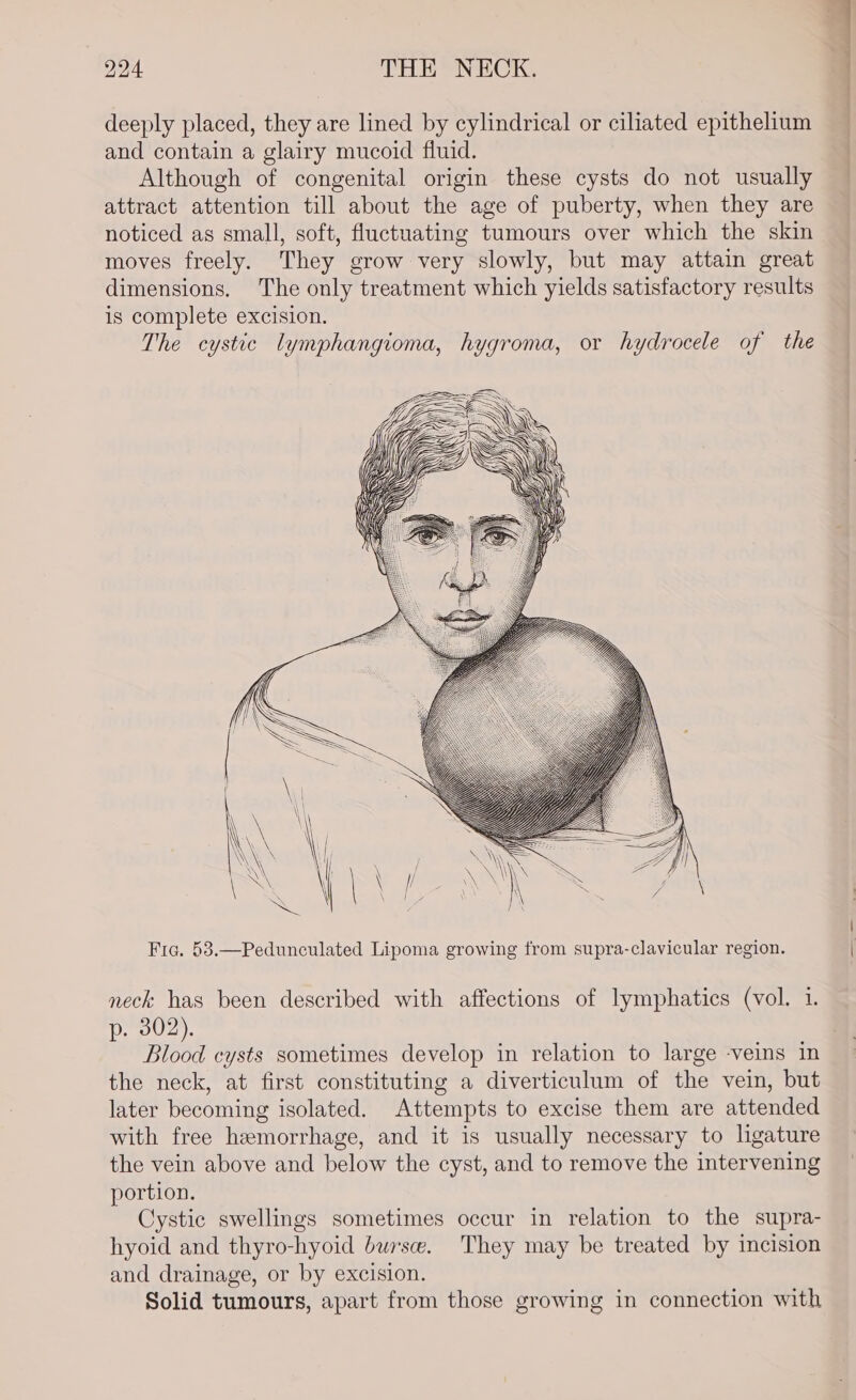deeply placed, they are lined by cylindrical or ciliated epithelium and contain a glairy mucoid fluid. Although of congenital origin these cysts do not usually attract attention till about the age of puberty, when they are noticed as small, soft, fluctuating tumours over which the skin moves freely. They grow very slowly, but may attain great dimensions. The only treatment which yields satisfactory results is complete excision. The cystic lymphangioma, hygroma, or hydrocele of the Fic. 58.—Pedunculated Lipoma growing from supra-clavicular region. neck has been described with affections of lymphatics (vol. 1. p. 302). Blood cysts sometimes develop in relation to large -veins in the neck, at first constituting a diverticulum of the vein, but later becoming isolated. Attempts to excise them are attended with free hemorrhage, and it is usually necessary to ligature the vein above and below the cyst, and to remove the intervening portion. Cystic swellings sometimes occur in relation to the supra- hyoid and thyro-hyoid burse. They may be treated by incision and drainage, or by excision. Solid tumours, apart from those growing in connection with
