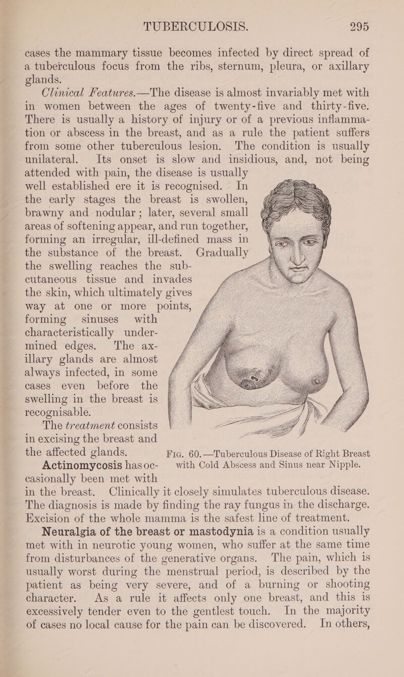 cases the mammary tissue becomes infected by direct spread of a tuberculous focus from the ribs, sternum, pleura, or axillary glands. Cloncal Features.—The disease is almost invariably met with in women between the ages of twenty-five and thirty-five. There is usually a history of injury or of a previous inflamma- tion or abscess in the breast, and as a rule the patient suffers from some other tuberculous lesion. The condition is usually unilateral. Its onset is slow and insidious, and, not being attended with pain, the disease is usually well established ere it is recognised. In the early stages the breast is swollen, brawny and nodular; later, several small areas of softening appear, and run together, forming an irregular, ill-defined mass in the substance of the breast. Gradually the swelling reaches the sub- cutaneous tissue and invades the skin, which ultimately gives way at one or more points, forming sinuses with characteristically under- mined edges. The ax- illary glands are almost always infected, in some cases even before the swelling in the breast is _ recognisable. The treatment consists in excising the breast and : the affected glands. Fig. 60.—Tuberculous Disease of Right Breast Actinomycosis hasoc- with Cold Abscess and Sinus near Nipple. casionally been met with in the breast. Clinically it closely simulates tuberculous disease. The diagnosis is made by finding the ray fungus in the discharge. Excision of the whole mamma is the safest line of treatment. Neuralgia of the breast or mastodynia is a condition usually met with in neurotic young women, who suffer at the same time from disturbances of the generative organs. The pain, which is usually worst during the menstrual period, is described by the patient as being very severe, and of a burning or shooting character. As a rule it affects only one breast, and this 1s excessively tender even to the gentlest touch. In the majority of cases no local cause for the pain can be discovered. In others,