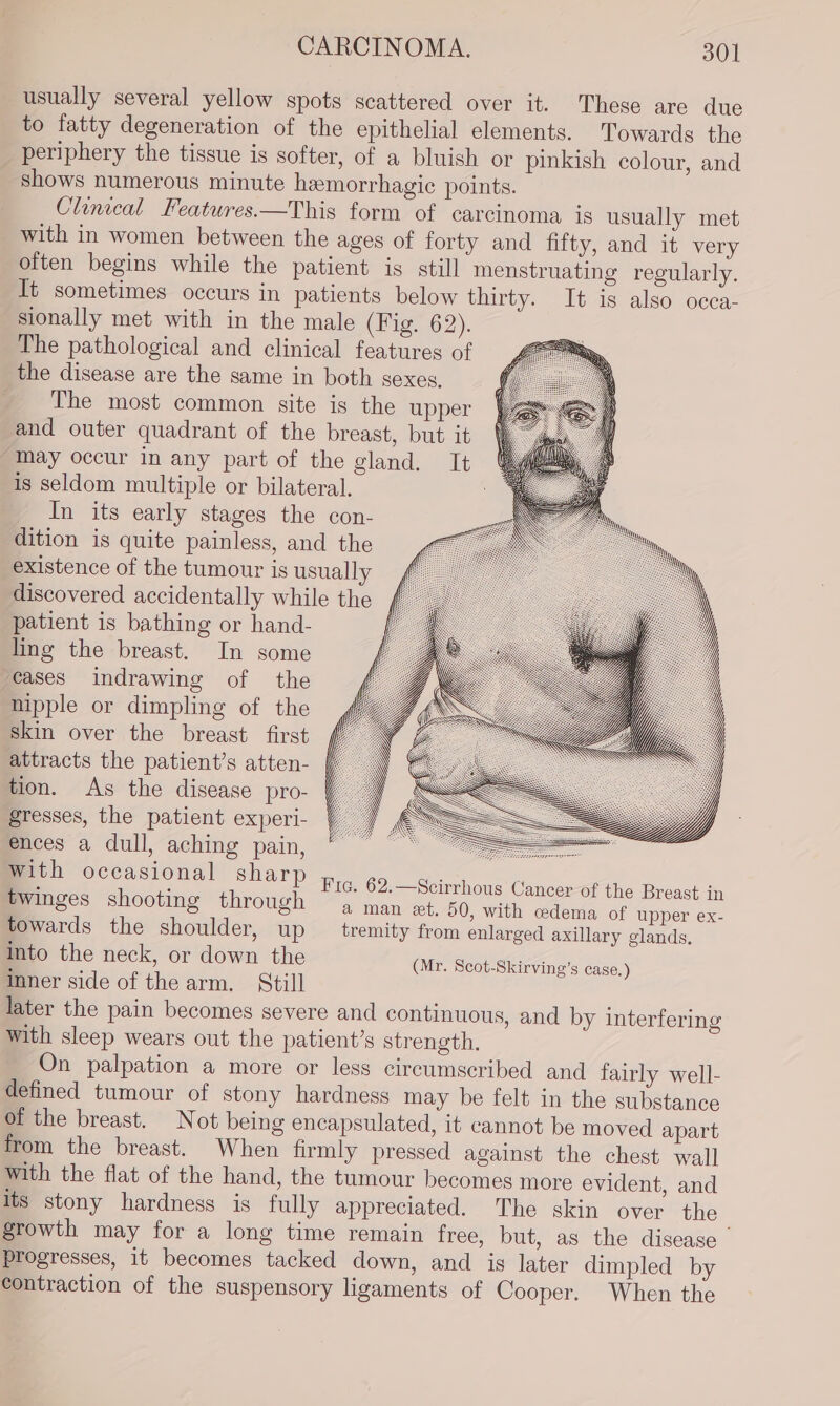 usually several yellow spots scattered over it. These are due to fatty degeneration of the epithelial elements. Towards the periphery the tissue is softer, of a bluish or pinkish colour, and Shows numerous minute hemorrhagic points. Clinical Features.—This form of carcinoma is usually met with in women between the ages of forty and fifty, and it very often begins while the patient is still menstruating regularly. It sometimes occurs in patients below thirty. It is also occa- sionally met with in the male (Fig. 62). The pathological and clinical features of the disease are the same in both sexes, The most common site is the upper and outer quadrant of the breast, but it may occur in any part of the gland. It is seldom multiple or bilateral. In its early stages the con- dition is quite painless, and the existence of the tumour is usually discovered accidentally while the patient is bathing or hand- ling the breast. In some ‘cases indrawing of the nipple or dimpling of the skin over the breast first attracts the patient’s atten- tion. As the disease pro- gresses, the patient experi- ences a dull, aching pain, with occasional sharp Fie. 62.—Scirrhous Cancer of the Breast in twinges shooting through “a man et. 50, with cedema of upper ex- towards the shoulder, up tremity from enlarged axillary glands. into the neck, or down the (Mr. Scot-Skirving’s case.) inner side of the arm. Still later the pain becomes severe and continuous, and by interfering with sleep wears out the patient’s strength. On palpation a more or less circumscribed and fairly well- defined tumour of stony hardness may be felt in the substance of the breast. Not being encapsulated, it cannot be moved apart from the breast. When firmly pressed against the chest wall with the flat of the hand, the tumour becomes more evident, and its stony hardness is fully appreciated. The skin over the growth may for a long time remain free, but, as the disease - progresses, it becomes tacked down, and is later dimpled by contraction of the suspensory ligaments of Cooper. When the