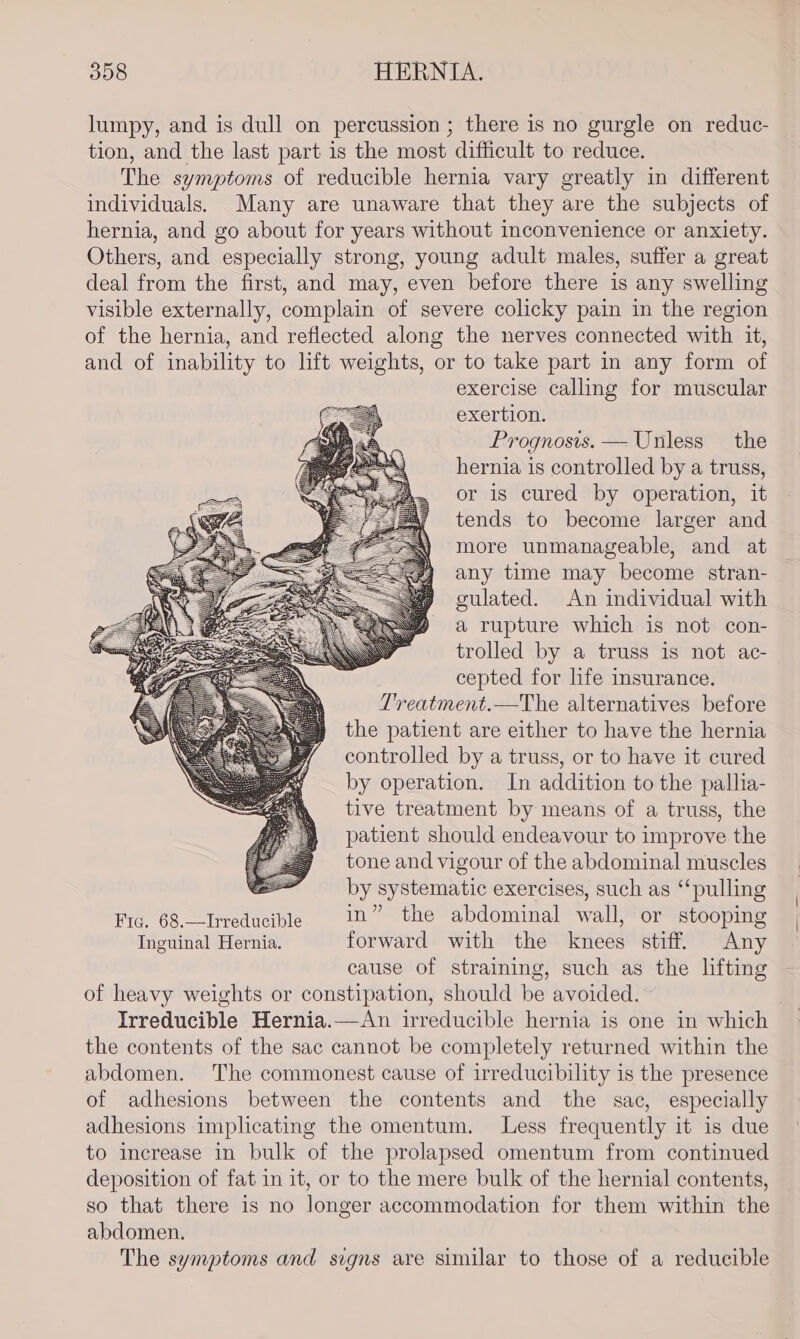 lumpy, and is dull on percussion ; there is no gurgle on reduc- tion, and the last part is the most difficult to reduce. The symptoms of reducible hernia vary greatly in different individuals. Many are unaware that they are the subjects of hernia, and go about for years without inconvenience or anxiety. Others, and especially strong, young adult males, suffer a great deal from the first, and may, even before there is any swelling visible externally, complain of severe colicky pain in the region of the hernia, and reflected along the nerves connected with it, and of inability to lift weights, or to take part in any form of exercise calling for muscular exertion. Prognosis. — Unless the hernia is controlled by a truss, or is cured by operation, it tends to become larger and more unmanageable, and at any time may become stran- gulated. An individual with a rupture which is not con- trolled by a truss is not ac- cepted for life insurance. Treatment.—The alternatives before the patient are either to have the hernia controlled by a truss, or to have it cured by operation. In addition to the pallia- tive treatment by means of a truss, the patient should endeavour to improve the tone and vigour of the abdominal muscles by systematic exercises, such as “‘pulling Fig. 68.—Irreducible in” the abdominal wall, or stooping Inguinal Hernia. forward with the knees stiff. Any cause of straining, such as the lifting of heavy weights or constipation, should be avoided. | Irreducible Hernia.—An irreducible hernia is one in which the contents of the sac cannot be completely returned within the abdomen. The commonest cause of irreducibility is the presence of adhesions between the contents and the sac, especially adhesions implicating the omentum. Less frequently it is due to increase in bulk of the prolapsed omentum from continued deposition of fat in it, or to the mere bulk of the hernial contents, so that there is no longer accommodation for them within the abdomen. The symptoms and signs are similar to those of a reducible