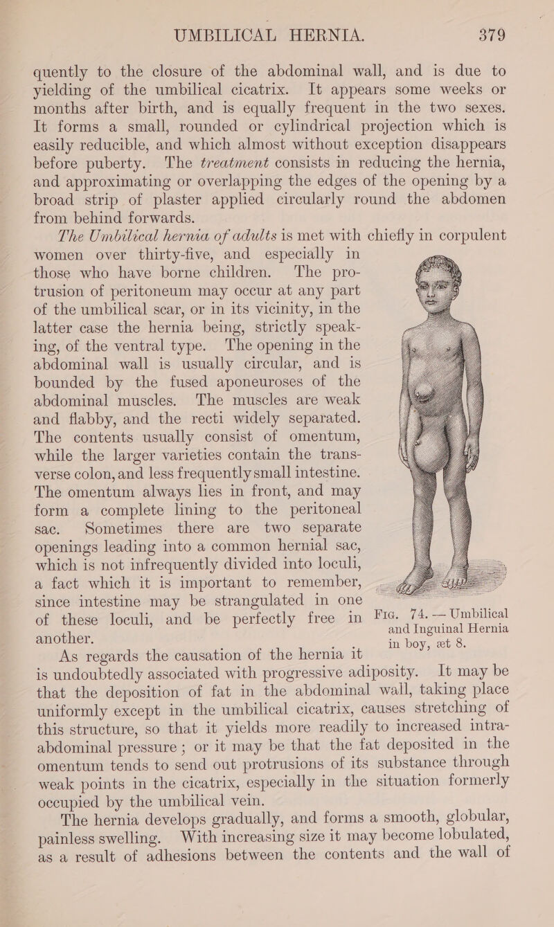 quently to the closure of the abdominal wall, and is due to yielding of the umbilical cicatrix. It appears some weeks or months after birth, and is equally frequent in the two sexes. It forms a small, rounded or cylindrical projection which is easily reducible, and which almost without exception disappears before puberty. The treatment consists in reducing the hernia, and approximating or overlapping the edges of the opening by a broad strip of plaster applied circularly round the abdomen from behind forwards. The Umbilical herma of adults is met with chiefly in corpulent women over thirty-five, and especially in = those who have borne children. The pro- trusion of peritoneum may occur at any part of the umbilical scar, or in its vicinity, in the latter case the hernia being, strictly speak- ing, of the ventral type. The opening in the abdominal wall is usually circular, and is bounded by the fused aponeuroses of the abdominal muscles. The muscles are weak and flabby, and the recti widely separated. The contents usually consist of omentum, while the larger varieties contain the trans- verse colon, and less frequently small intestine. The omentum always lies in front, and may form a complete lining to the peritoneal sac. Sometimes there are two separate openings leading into a common hernial sac, which is not infrequently divided into loculi, a fact which it is important to remember, since intestine may be strangulated in one — | of these loculi, and be perfectly free in Fic. 74.-— Umbilical and Inguinal Hernia another. in boy, et 8 As regards the causation of the hernia it is undoubtedly associated with progressive adiposity. It may be that the deposition of fat in the abdominal wall, taking place uniformly except in the umbilical cicatrix, causes stretching of this structure, so that it yields more readily to increased intra- abdominal pressure ; or it may be that the fat deposited in the omentum tends to send out protrusions of its substance through weak points in the cicatrix, especially in the situation formerly occupied by the umbilical vein. The hernia develops gradually, and forms a smooth, globular, painless swelling. With increasing size it may become lobulated, as a result of adhesions between the contents and the wall of