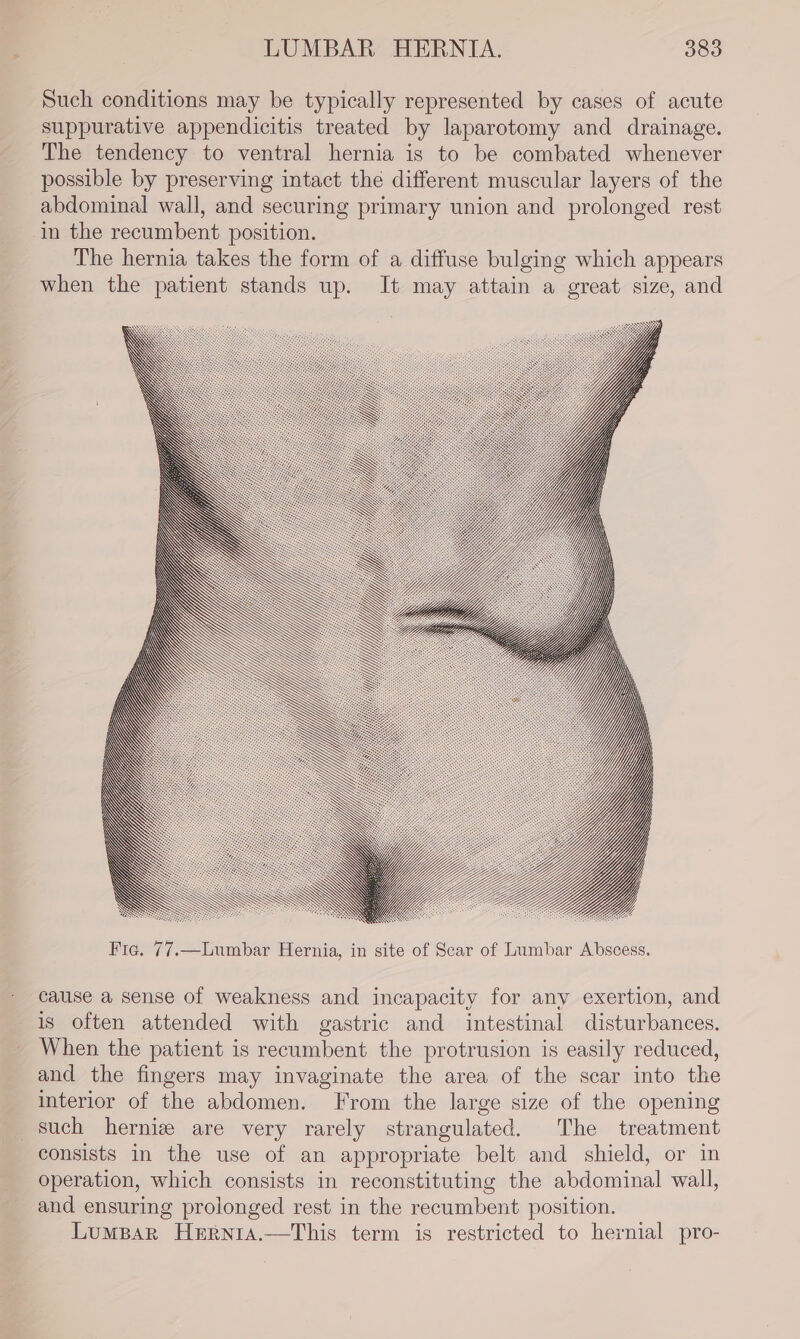 Such conditions may be typically represented by cases of acute suppurative appendicitis treated by laparotomy and drainage. The tendency to ventral hernia is to be combated whenever possible by preserving intact the different muscular layers of the abdominal wall, and securing primary union and prolonged rest in the recumbent position. The hernia takes the form of a diffuse bulging which appears when the patient stands up. It may attain a great size, and tj Oe Yi LZ LY WY Fig. 77.—Lumbar Hernia, in site of Scar of Lumbar Abscess. cause a sense of weakness and incapacity for any exertion, and is often attended with gastric and intestinal disturbances. When the patient is recumbent the protrusion is easily reduced, and the fingers may invaginate the area of the scar into the interior of the abdomen. From the large size of the opening such herniz are very rarely strangulated. The treatment consists in the use of an appropriate belt and shield, or in operation, which consists in reconstituting the abdominal wall, and ensuring prolonged rest in the recumbent position. Lumpar Hrrnia.—This term is restricted to hernial pro-