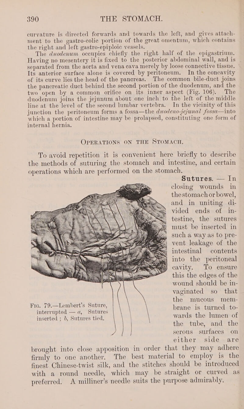 curvature is directed forwards and towards the left, and gives attach- ment to the gastro-colic portion of the great omentum, which contains the right and left gastro-epiploic vessels. The duodenwm occupies chiefly the right half of the epigastrium. Having no mesentery it is fixed to the posterior abdominal wall, and is separated from the aorta and vena cava merely by loose connective tissue. Its anterior surface alone is covered by peritoneum. In the concavity of its curve lies the head of the pancreas. The common bile-duct joins the pancreatic duct behind the second portion of the duodenum, and the two open by a common orifice on its inner aspect (Fig. 106). The duodenum joins the jejunum about one inch to the left of the middle line at the level of the second lumbar vertebra. In the vicinity of this junction the peritoneum forms a fossa—the duodeno-jejunal fossa—into which a portion of intestine may be prolapsed, constituting one form of internal hernia. OPERATIONS ON THE STOMACH, To avoid repetition it is convenient here briefly to describe the methods of suturing the stomach and intestine, and certain operations which are performed on the stomach. Sutures. — In closing wounds in the stomach or bowel, and in uniting di vided ends of in- testine, the sutures must be inserted in such a way as to pre- vent leakage of the intestinal contents into the peritoneal cavity. To ensure this the edges of the wound should be in- vaginated so that the mucous mem- Fra. 79.—Lembert's Suture, LAs air Cd meee interrupted — a, Sutures inserted ; b, Sutures tied. wards the lumen of the tube, and the serous surfaces on either side are brought into close apposition in order that they may adhere firmly to one another. The best material to employ is the finest Chinese-twist silk, and the stitches should be introduced with a round needle, which may be straight or curved as preferred. A milliner’s needle suits the purpose admirably.