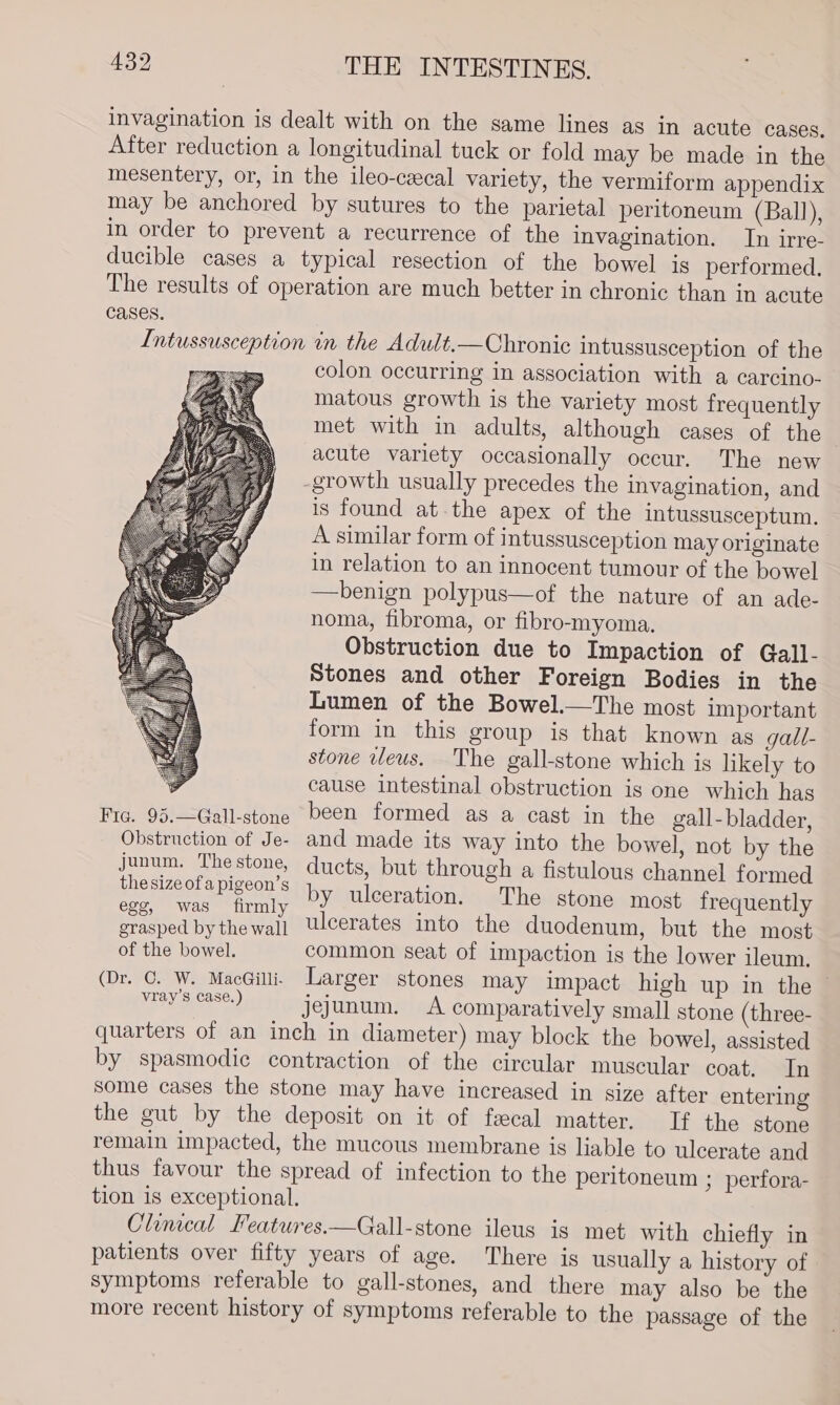 invagination is dealt with on the same lines as in acute cases. After reduction a longitudinal tuck or fold may be made in the mesentery, or, in the ileo-ceecal variety, the vermiform appendix may be anchored by sutures to the parietal peritoneum (Ball), in order to prevent a recurrence of the invagination. In irre- ducible cases a typical resection of the bowel is performed, The results of operation are much better in chronic than in acute Cases. Intussusception in the Adult.—Chronic intussusception of the colon occurring in association with a carcino- matous growth is the variety most frequently met with in adults, although cases of the acute variety occasionally occur. The new growth usually precedes the invagination, and is found at the apex of the intussusceptum. A similar form of intussusception may originate in relation to an innocent tumour of the bowel —benign polypus—of the nature of an ade- noma, fibroma, or fibro-myoma. Obstruction due to Impaction of Gall- Stones and other Foreign Bodies in the Lumen of the Bowel.—The most important form in this group is that known as gall- stone veus. The gall-stone which is likely to cause intestinal obstruction is one which has Fic. 95.—Gall-stone been formed as a cast in the gall- bladder, Obstruction of Je- and made its way into the bowel, not by the junum. Thestone, ducts, but through a fistulous channel formed este piece Sih yerulcorationdaaThemstos most frequently weve bythewal! ulcerates into the duod but th grasped by thewail Wicerates into the duodenum, but the most of the bowel. common seat of impaction is the lower ileum. (Dr. C. W. MacGini. Larger stones may impact high up in the es DENS jejunum. A comparatively small stone (three- quarters of an inch in diameter) may block the bowel, assisted by spasmodic contraction of the circular muscular coat. In some cases the stone may have increased in size after entering the gut by the deposit on it of fecal matter. If the stone remain impacted, the mucous membrane is liable to ulcerate and thus favour the spread of infection to the peritoneum ; perfora- tion is exceptional. Climcal Features.—Gall-stone ileus is met with chiefly in patients over fifty years of age. There is usually a history of symptoms referable to gall-stones, and there may also be the more recent history of symptoms referable to the passage of the