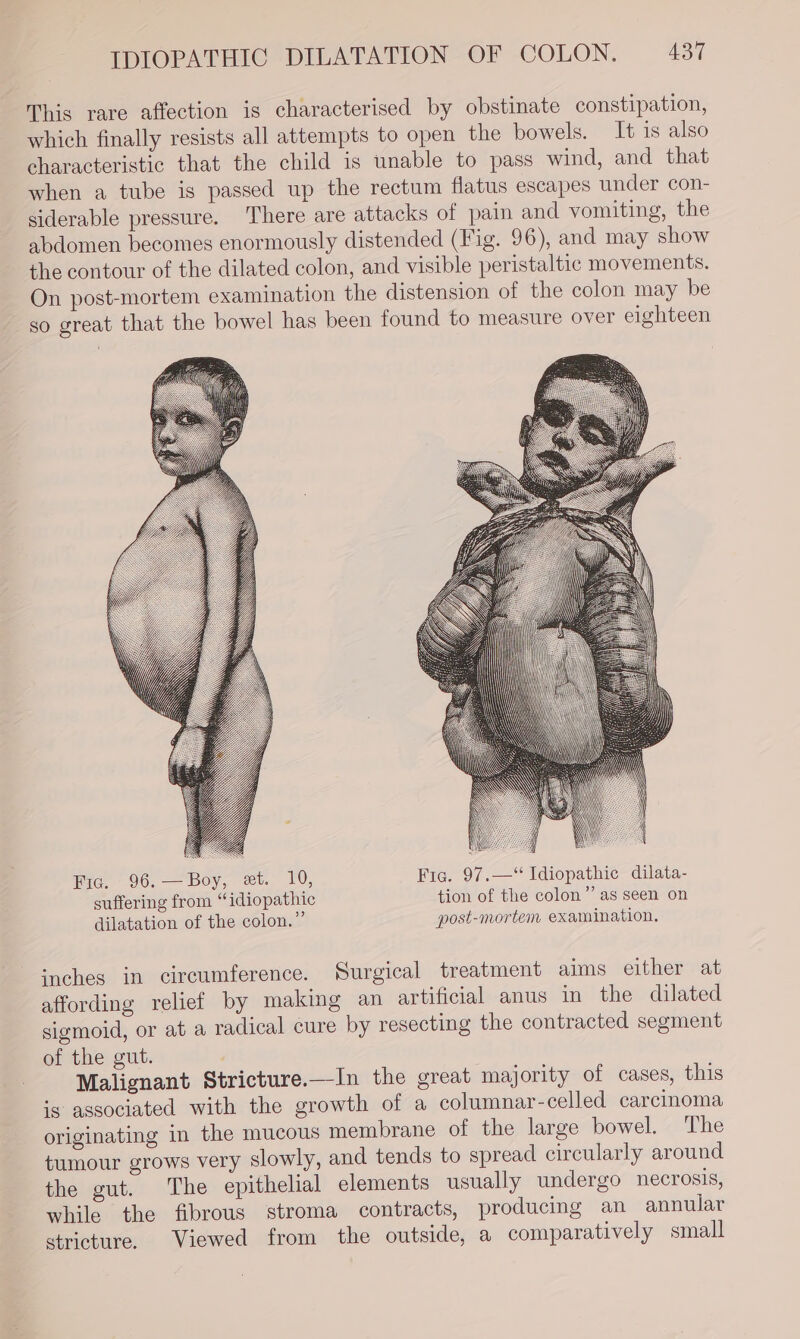 This rare affection is characterised by obstinate constipation, which finally resists all attempts to open the bowels. It is also characteristic that the child is unable to pass wind, and that when a tube is passed up the rectum flatus escapes under con- siderable pressure. There are attacks of pain and vomiting, the abdomen becomes enormously distended (Fig. 96), and may show the contour of the dilated colon, and visible peristaltic movements. On post-mortem examination the distension of the colon may be so great that the bowel has been found to measure over eighteen Eic. - 96. — Boy, et. 10, Fic. 97.—“‘ Idiopathic dilata- suffering from “idiopathic tion of the colon” as seen on dilatation of the colon.” post-mortem examination. inches in circumference. Surgical treatment aims either at affording relief by making an artificial anus in the dilated sigmoid, or at a radical cure by resecting the contracted segment of the gut. Malignant Stricture.—-In the great majority of cases, this is associated with the growth of a columnar-celled carcinoma originating in the mucous membrane of the large bowel. The tumour grows very slowly, and tends to spread circularly around the gut. The epithelial elements usually undergo necrosis, while the fibrous stroma contracts, producing an annular stricture. Viewed from the outside, a comparatively small