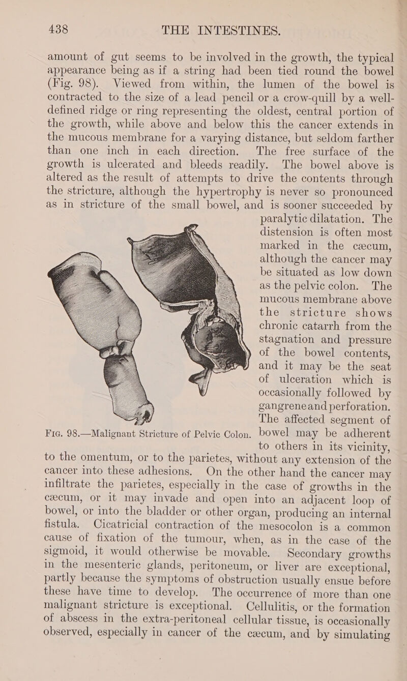 amount of gut seems to be involved in the growth, the typical appearance being as if a string had been tied round the bowel (Fig. 98). Viewed from within, the lumen of the bowel is contracted to the size of a lead pencil or a crow-quill by a well- defined ridge or ring representing the oldest, central portion of the growth, while above and below this the cancer extends in the mucous membrane for a varying distance, but seldom farther than one inch in each direction. The free surface of the growth is ulcerated and bleeds readily. The bowel above is altered as the result of attempts to drive the contents through the stricture, although the hypertrophy is never so pronounced as in stricture of the small bowel, and is sooner succeeded by paralytic dilatation. The distension is often most marked in the caecum, although the cancer may be situated as low down as the pelvic colon. The mucous membrane above the stricture shows chronic catarrh from the stagnation and pressure of the bowel contents, and it may be the seat of ulceration which is occasionally followed by gangreneand perforation. : The affected segment of Frc. 98.—Malignant Stricture of Pelvic Colon, bowel may be adherent to others in its vicinity, to the omentum, or to the parietes, without any extension of the cancer into these adhesions. On the other hand the cancer may infiltrate the parietes, especially in the case of growths in the cecum, or it may invade and open into an adjacent loop of bowel, or into the bladder or other organ, producing an internal fistula. Cicatricial contraction of the mesocolon is a common cause of fixation of the tumour, when, as in the case of the sigmoid, it would otherwise be movable. Secondary growths in the mesenteric glands, peritoneum, or liver are exceptional, partly because the symptoms of obstruction usually ensue before these have time to develop. The occurrence of more than one malignant stricture is exceptional. Cellulitis, or the formation of abscess in the extra-peritoneal cellular tissue, is occasionally observed, especially in cancer of the cecum, and by simulating