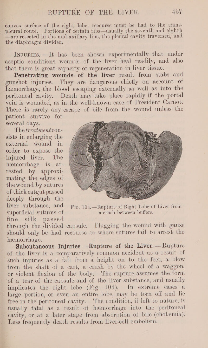 convex surface of the right lobe, recourse must be had to the trans- pleural route. Portions of certain ribs—usually the seventh and eighth —are resected in the mid-axillary line, the pleural cavity traversed, and the diaphragm divided. InsuriEs.—It has been shown experimentally that under aseptic conditions wounds of the liver heal readily, and also that there is great capacity of regeneration in liver tissue. Penetrating wounds of the liver result from stabs and gunshot injuries. They are dangerous chiefly on account of hemorrhage, the blood escaping externally as well as into the peritoneal cavity. Death may take place rapidly if the portal vein is wounded, as in the well-known case of President Carnot. There is rarely any escape of bile from the wound unless the patient survive for several days. The treatment con- sists in enlarging the external wound in order to expose the injured liver. The hemorrhage is ar- rested by approxi- mating the edges of the wound by sutures of thick catgut passed deeply through the liver substance, and Fic. 104.—Rupture of Right Lobe of Liver from superficial sutures of a crush between buffers. ane silk passed through the divided capsule. Plugging the wound with gauze should only be had recourse to where sutures fail to arrest the hemorrhage. Subcutaneous Injuries——Rupture of the Liver.— hupture of the liver is a comparatively common accident as a result of such injuries as a fall from a height on to the feet, a blow from the shaft of a cart, a crush by the wheel of a waggon, or violent flexion of the body. The rupture assumes the form of a tear of the capsule and of the liver substance, and usually implicates the right lobe (Fig. 104). In extreme cases a large portion, or even an entire lobe, may be torn off and he free in the peritoneal cavity. The condition, if left to nature, 1s usually fatal as a result of hemorrhage into the peritoneal cavity, or at a later stage from absorption of bile (cholemia). Less frequently death results from liver-cell embolisin.