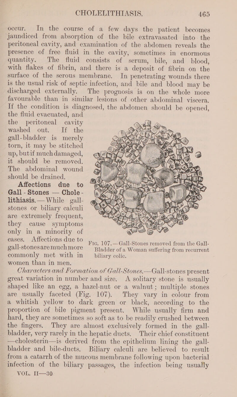 occur. In the course of a few days the patient becomes jaundiced from absorption of the bile extravasated into. the peritoneal cavity, and examination of the abdomen reveals the presence of free fluid in the cavity, sometimes in enormous quantity. The fluid consists of serum, bile, and blood, with flakes of fibrin, and there is a deposit of fibrin on the surface of the serous membrane. In penetrating wounds there is the usual risk of septic infection, and bile and blood may be discharged externally. The prognosis is on the whole more favourable than in similar lesions of other abdominal viscera. If the condition is diagnosed, the abdomen should be opened, the fluid evacuated, and the peritoneal cavity washed out. If the gall-bladder is merely torn, it may be stitched - up, butif much damaged, it should be removed. The abdominal wound should be drained. Affections due to Gall - Stones — Chole - lithiasis. — While gall- stones or biliary calculi are extremely frequent, they cause symptoms only in a minority of cases, Affections due to Fra. 107. — Gall-Stones removed from the Gall- gall-stonesare much more Bladder of a Woman suffering from recurrent commonly met with in biliary colic. women than in men. Characters and Formation of Gall-Stones.—Gall-stones present great variation in number and size. A solitary stone is usually shaped like an egg, a hazel-nut or a walnut; multiple stones are usually faceted (Fig. 107). They vary in colour from a whitish yellow to dark green or black, according to the proportion of bile pigment present. While usually firm and hard, they are sometimes so soft as to be readily crushed between the fingers. They are almost exclusively formed in the gall- bladder, very rarely in the hepatic ducts. Their chief constituent —cholesterin—is derived from the epithelium lining the gall- bladder and bile-ducts. Biliary calculi are believed to result from a catarrh of the mucous membrane following upon bacterial infection of the biliary passages, the infection being usually VOL. II—30 |