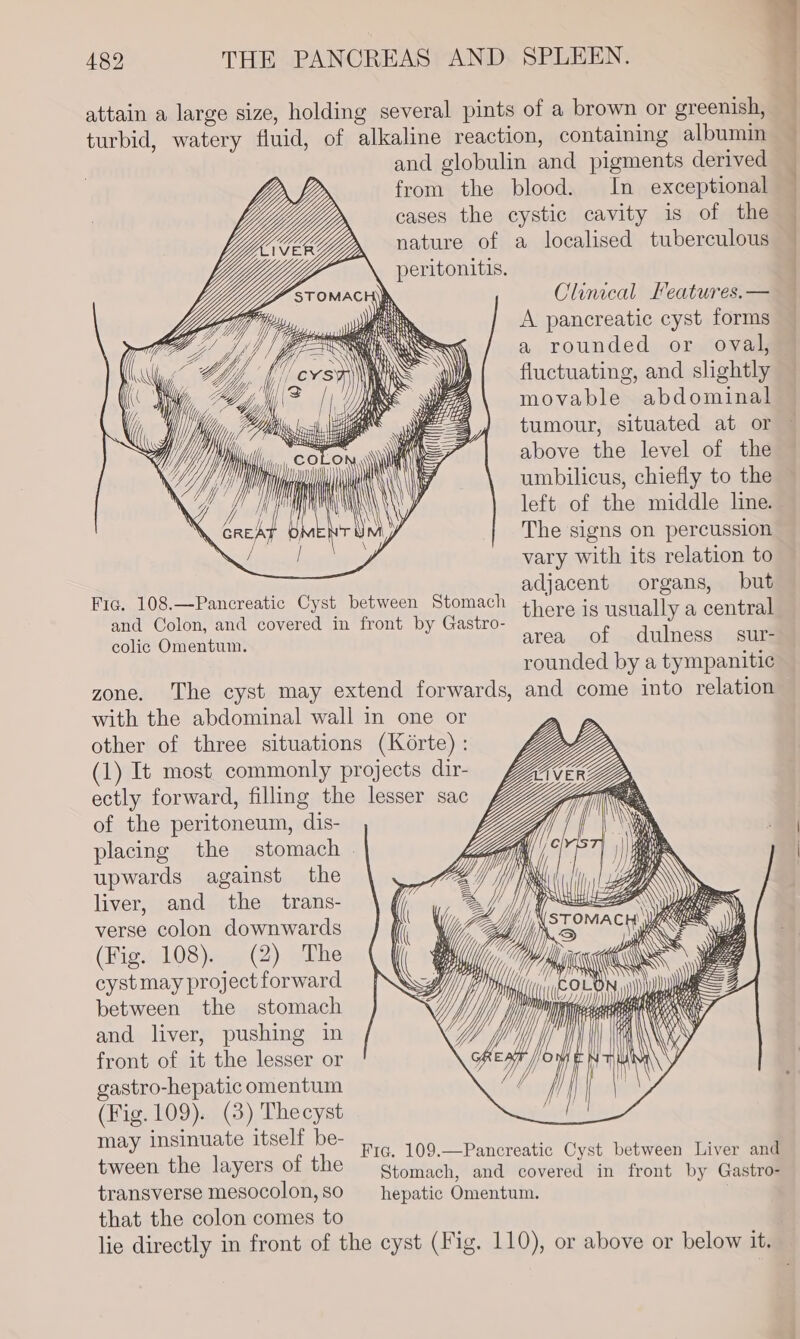 hi n 482 THE PANCREAS AND SPLEEN. attain a large size, holding several pints of a brown or greenish, turbid, watery fluid, of alkaline reaction, containing albumin and globulin and pigments derived from the blood. In exceptional cases the cystic cavity is of the / nature of a localised tuberculous | peritonitis. Clinical Features.— A pancreatic cyst forms a rounded or oval, fluctuating, and slightly movable abdominal tumour, situated at or above the level of the umbilicus, chiefly to the left of the middle line. The signs on percussion vary with its relation to ' adjacent organs, but Fia. 108.—Pancreatic Cyst between Stomach and Colon, and covered in front by Gastro- there is usually a central colic Omentum. area of dulness sur- rounded by a tympanitic zone. The cyst may extend forwards, and come into relation with the abdominal wall in one or other of three situations (Korte) : (1) It most commonly projects dir- ectly forward, filling the lesser sac of the peritoneum, dis- placing the stomach | upwards against the liver, and the trans- verse colon downwards (Fig. 108). (2) The cyst may project forward between the stomach and liver, pushing in front of it the lesser or gastro-hepatic omentum (Fig. 109). (3) Thecyst Taye Smale itselt be- Fic. 109.—Pancreatic Cyst between Liver and tween the layers of the Stomach, and covered in front by Gastro- transverse mesocolon, so hepatic Omentum. that the colon comes to | lie directly in front of the cyst (Fig. 110), or above or below it. i _—— Ww SS ~Z \ \ ey ~ at \ GRE rims l |}