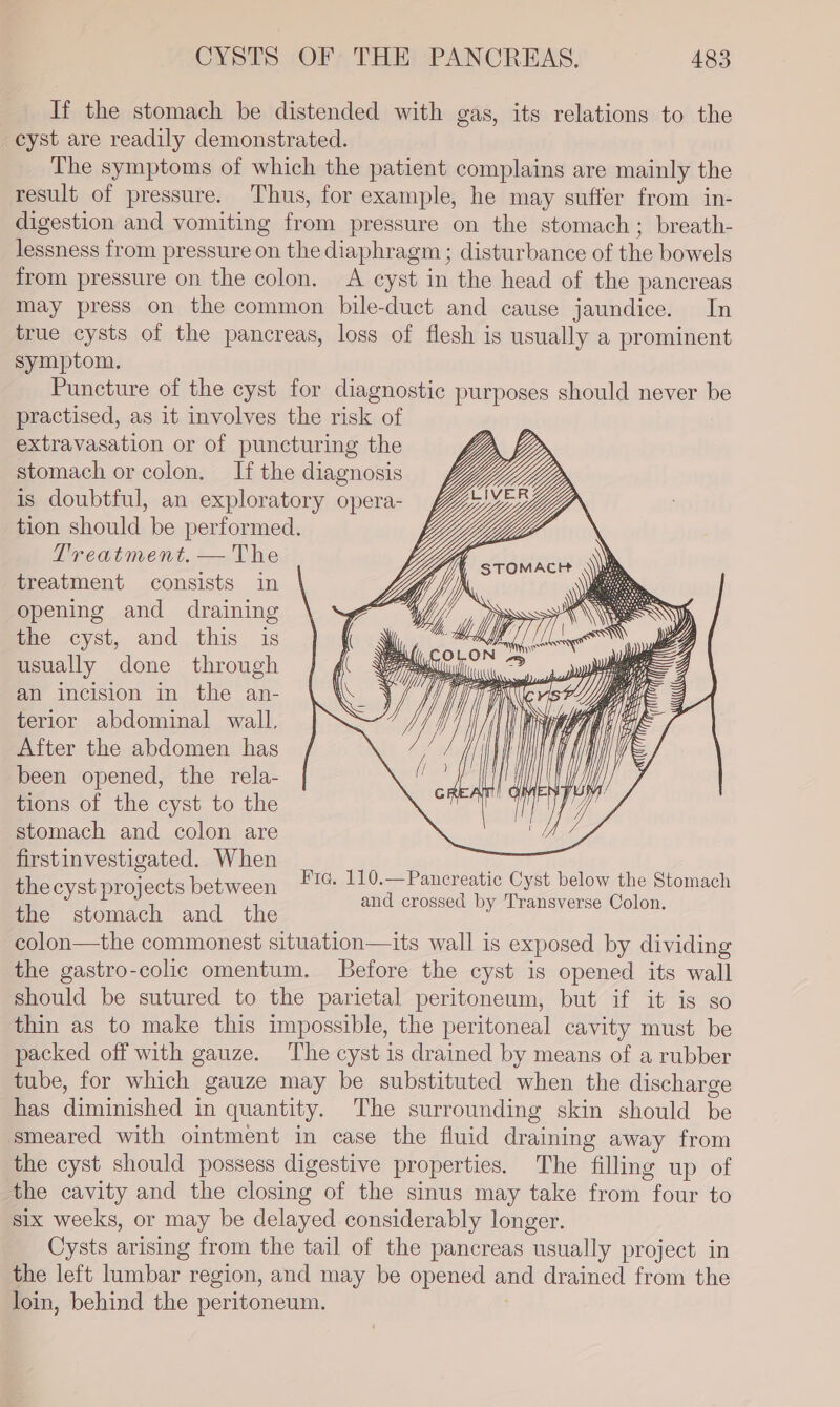 If the stomach be distended with gas, its relations to the cyst are readily demonstrated. The symptoms of which the patient complains are mainly the result of pressure. Thus, for example, he may suffer from in- digestion and vomiting from pressure on the stomach; breath- lessness from pressure on the diaphragm ; disturbance of the bowels from pressure on the colon. A cyst in the head of the pancreas may press on the common bile-duct and cause jaundice. In true cysts of the pancreas, loss of flesh is usually a prominent symptom. Puncture of the cyst for diagnostic purposes should never be practised, as it involves the risk of extravasation or of puncturing the stomach or colon. If the diagnosis is doubtful, an exploratory opera- tion should be performed. Treatment. — The treatment consists in opening and draining the cyst, and this is ! usually done through ( an incision in the an- terior abdominal wall. After the abdomen has been opened, the rela- tions of the cyst to the stomach and colon are » firstinvestigated. When the cyst projects between the stomach and the colon—the commonest situation—its wall is exposed by dividing the gastro-colic omentum. Before the cyst is opened its wall should be sutured to the parietal peritoneum, but if it is so thin as to make this impossible, the peritoneal cavity must be packed off with gauze. ‘The cyst is drained by means of a rubber tube, for which gauze may be substituted when the discharge has diminished in quantity. The surrounding skin should be smeared with ointment in case the fluid draining away from the cyst should possess digestive properties. The filling up of the cavity and the closing of the sinus may take from four to six weeks, or may be delayed considerably longer. Cysts arising from the tail of the pancreas usually project in the left lumbar region, and may be opened and drained from the loin, behind the peritoneum. Fic. 110.—Pancreatic Cyst below the Stomach and crossed by Transverse Colon.