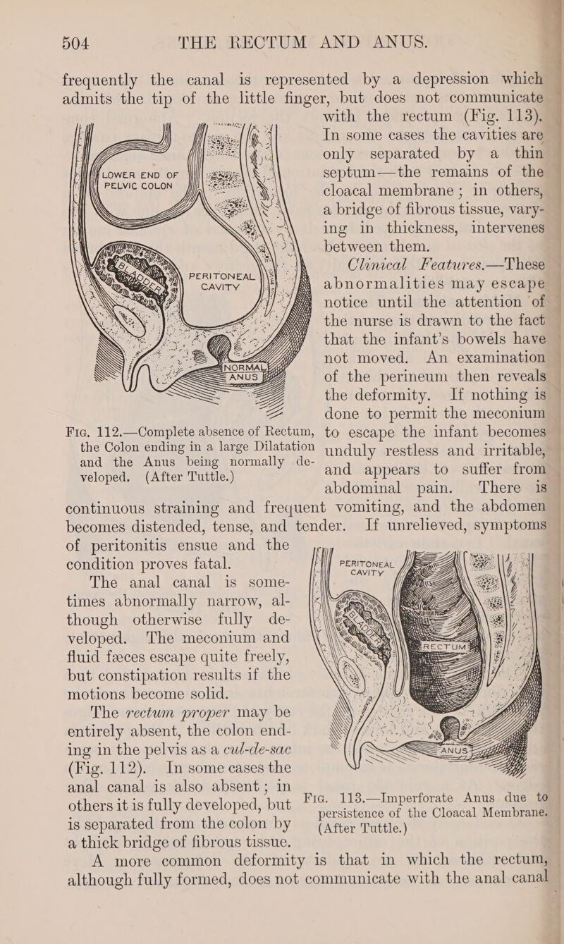 cloacal membrane ; in others, a bridge of fibrous tissue, vary- ing in thickness, intervenes between them. . aoe Clinical Features.—These PERITONEAL }\\\3} . Cane cavity jah abnormalities may escape : notice until the attention of the nurse is drawn to the fact that the infant’s bowels have not moved. An examination of the perineum then reveals the deformity. If nothing is ae done to permit the meconium Fria, 112.—Complete absence of Rectum, to escape the infant becomes the Colon ending in a large Dilatation yndylv restless ; ca and the Anus being normally de- sme lar ®: leone veloped. (After Tuttle.) and ba ec to suffer from abdominal pain. There 1s continuous straining and frequent vomiting, and the abdomen becomes distended, tense, and tender. If unrelieved, symptoms of peritonitis ensue and the condition proves fatal. ‘TIP PERITONEAL . Sam CAVITY The anal canal is some- | times abnormally narrow, al- though otherwise fully de- veloped. The meconium and fluid feeces escape quite freely, but constipation results if the motions become solid. The rectum proper may be entirely absent, the colon end- ing in the pelvis as a cul-de-sac (Fig. 112). In some cases the anal canal is also absent ; in others Bas Uo rele neds itt ca ae of ae Coda ea is separated from the colon by (After Tuttle.) a thick bridge of fibrous tissue. A more common deformity is that in which the rectum, although fully formed, does not communicate with the anal canal an iS