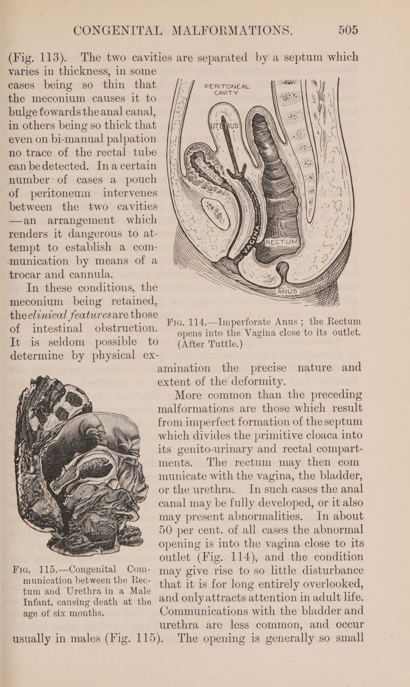 cases being so thin that the meconium causes it to bulge towards theanal canal, in others being so thick that even on bi-manual palpation no trace of the rectal tube can bedetected. Ina certain number: of cases a pouch of peritoneum intervenes between the two cavities —an arrangement which renders it dangerous to at- tempt to establish a com- munication by means of a trocar and cannula. In these conditions, the meconium being retained, theclinical featuresare those of intestinal obstruction. It is seldom possible to determine by physical ex- &amp; os PERITONEAL CAVITY Fria. 114.—Imperforate Anus ; the Rectum opens into the Vagina close to its outlet. (After Tuttle.) More common than the preceding Fig. 115.-—Congenital Com- munication between the Rec- tum and Urethra in a Male Infant, causing death at the age of six months. malformations are those which result from imperfect formation of the septum which divides the primitive cloaca into its genito-urinary and rectal compart- ments. The rectum may then com municate with the vagina, the bladder, or the urethra. In such cases the anal canal may be fully developed, or it also may present abnormalities. In about 50 per cent. of all cases the abnormal opening is into the vagina close to its outlet (Fig. 114), and the condition may give rise to so little disturbance that it is for long entirely overlooked, and onlyattracts attention in adult life. Communications with the bladder and urethra are less common, and occur