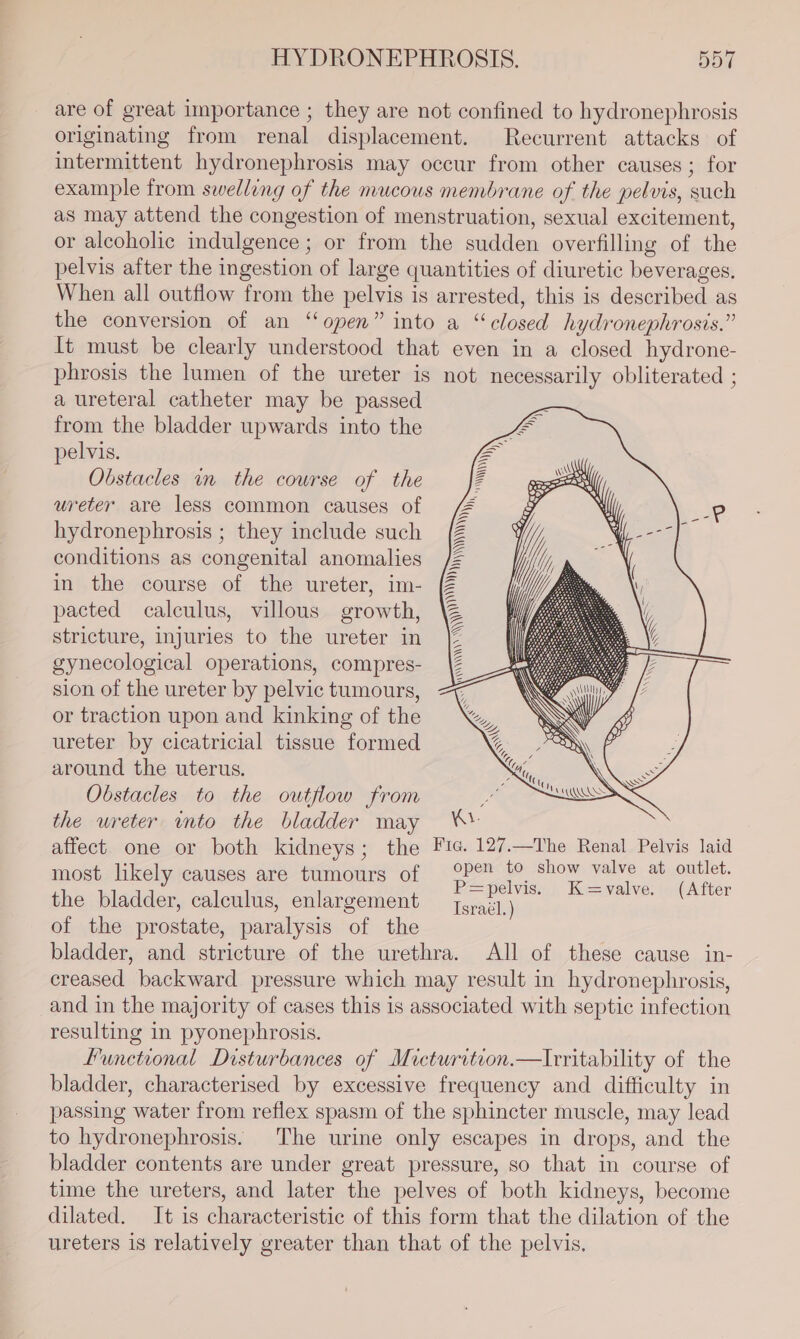 are of great importance ; they are not confined to hydronephrosis originating from renal displacement. Recurrent attacks of intermittent hydronephrosis may occur from other causes ; for example from swelling of the mucous membrane of the pelvis, such as may attend the congestion of menstruation, sexual excitement, or alcoholic indulgence; or from the sudden overfilling of the pelvis after the ingestion of large quantities of diuretic beverages. When all outflow from the pelvis is arrested, this is described as the conversion of an “open” into a “closed hydronephrosis.” It must be clearly understood that even in a closed hydrone- phrosis the lumen of the ureter is not necessarily obliterated ; a ureteral catheter may be passed from the bladder upwards into the pelvis. Obstacles in the course of the ureter are less common causes of hydronephrosis ; they include such conditions as congenital anomalies in the course of the ureter, im- pacted calculus, villous growth, stricture, injuries to the ureter in gynecological operations, compres- sion of the ureter by pelvic tumours, or traction upon and kinking of the ureter by cicatricial tissue formed around the uterus. Obstacles to the outflow from the ureter into the bladder may affect one or both kidneys ; the Fia. 127.—The Renal Pelvis laid most likely causes are tumours of — 4P&amp; bo homnmelve, abyoritlet. : =pelvis. K=valve. (After the bladder, calculus, enlargement Tsraél.) of the prostate, paralysis of the bladder, and stricture of the urethra. All of these cause in- creased backward pressure which may result in hydronephrosis, and in the majority of cases this is associated with septic infection resulting in pyonephrosis. Functional Disturbances of Micturition.—Irritability of the bladder, characterised by excessive frequency and difficulty in passing water from reflex spasm of the sphincter muscle, may lead to hydronephrosis. The urine only escapes in drops, and the bladder contents are under great pressure, so that in course of time the ureters, and later the pelves of both kidneys, become dilated. It is characteristic of this form that the dilation of the ureters is relatively greater than that of the pelvis,