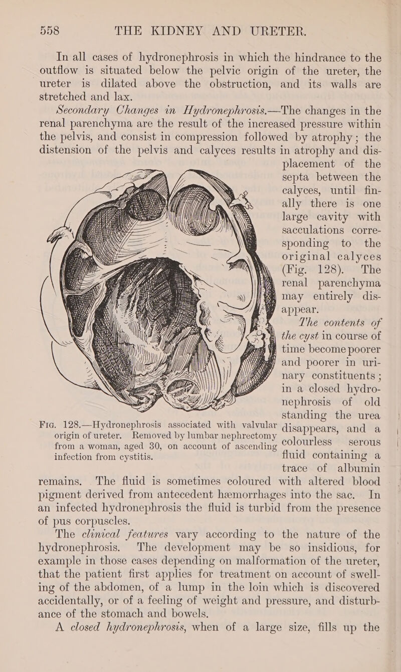 In all cases of hydronephrosis in which the hindrance to the outflow is situated below the pelvic origin of the ureter, the ureter is dilated above the obstruction, and its walls are stretched and lax. Secondary Changes in Hydronephrosis.—The changes in the renal parenchyma are the result of the increased pressure within the pelvis, and consist in compression followed by atrophy; the distension of the pelvis and calyces results in atrophy and dis- placement of the septa between the calyces, until fin- ally there is one large cavity with te } : sacculations corre- ae \\ sponding to the ee original calyces (Fig. 128). The renal parenchyma ) may entirely dis- q appear. : The contents of the cyst in course of f time become poorer y and poorer in uri- nary constituents ; in a closed hydro- nephrosis of old . standing the urea Fia. 128.—Hydronephrosis associated with valvular disappears, and a origin of ureter. Removed by lumbar nephrectomy Slourl : from a woman, aged 30, on account of ascending . AS ess : cae ds infection from cystitis. fluid containing a trace of albumin remains. The fluid is sometimes coloured with altered blood pigment derived from antecedent hemorrhages into the sac. In an infected hydronephrosis the fluid is turbid from the presence of pus corpuscles. The clinical features vary according to the nature of the hydronephrosis. The development may be so insidious, for example in those cases depending on malformation of the ureter, that the patient first applies for treatment on account of swell- ing of the abdomen, of a lump in the loin which is discovered accidentally, or of a feeling of weight and pressure, and disturb- ance of the stomach and bowels. A closed hydronephrosis, when of a large size, fills up the