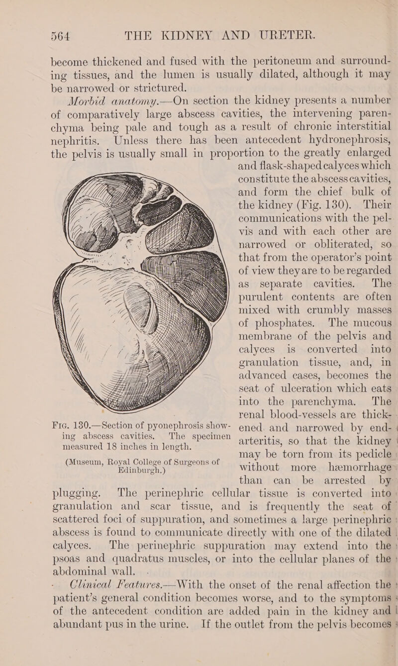 become thickened and fused with the peritoneum and surround- ing tissues, and the lumen is usually dilated, although it may be narrowed or strictured. Morbid anatomy.—On section the kidney presents a number of comparatively large abscess cavities, the intervening paren- chyma being pale and tough as a result of chronic interstitial nephritis. Unless there has been antecedent hydronephrosis, the pelvis is usually small in proportion to the greatly enlarged and flask-shaped calyces which constitute the abscess cavities, and form the chief bulk of the kidney (Fig. 130). Their communications with the pel- vis and with each other are narrowed or obliterated, so that from the operator’s point of view theyare to beregarded as separate cavities. The purulent contents are often mixed with crumbly masses of phosphates. The mucous membrane of the pelvis and calyces is converted into granulation tissue, and, in advanced cases, becomes the seat of ulceration which eats into the parenchyma. The renal blood-vessels are thick- ened, and narrowed by end- arteritis, so that the kidney ZZ ZZ Fia. 180.—Section of pyonephrosis show- ing abscess cavities. The specimen measured 18 inches in length. (Museum, Royal College of Surgeons of : faite ites Bes without more hemorrhage abdominal wall.