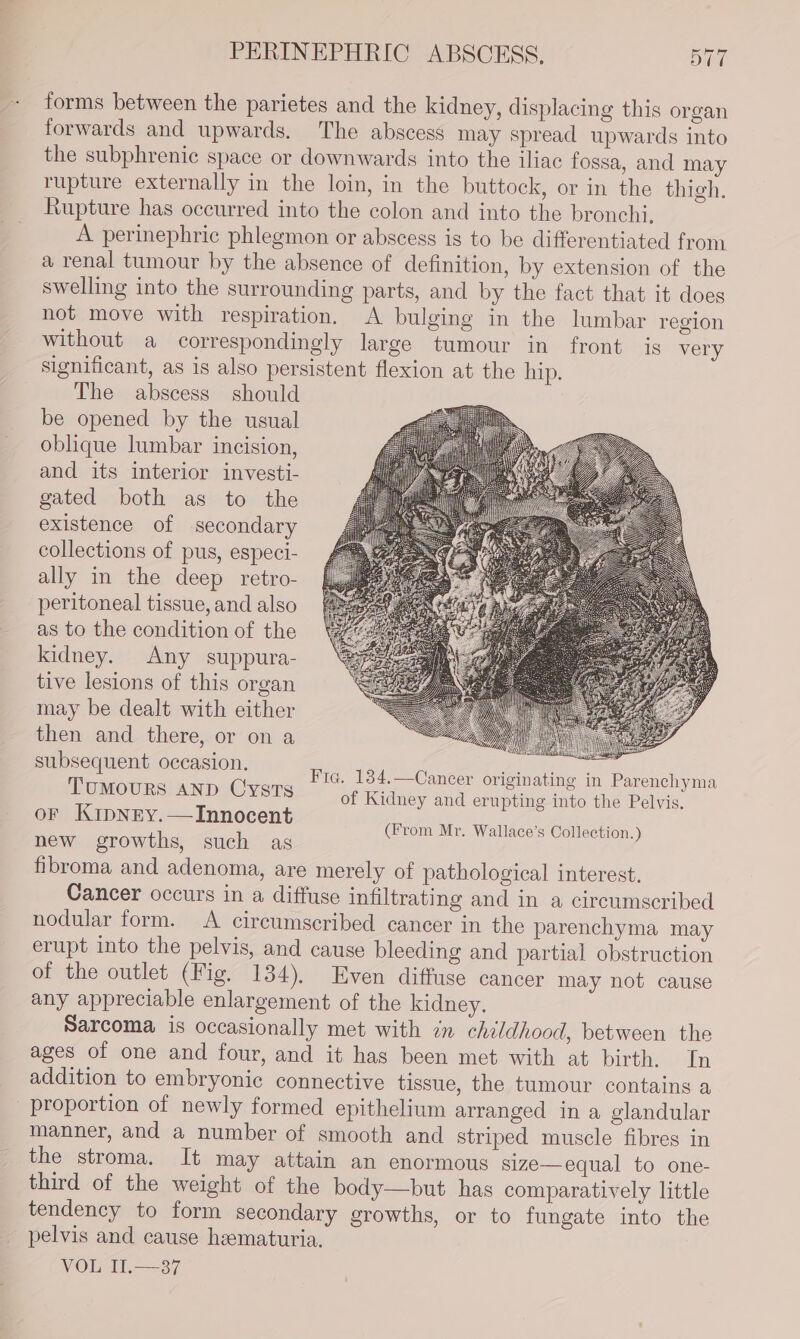 PERINEPHRIC ABSCESS, DTT forms between the parietes and the kidney, displacing this organ forwards and upwards. The abscess may spread upwards into the subphrenic space or downwards into the iliac fossa, and may rupture externally in the loin, in the buttock, or in the thigh. Rupture has occurred into the colon and into the bronchi, A perinephric phlegmon or abscess is to be differentiated from a renal tumour by the absence of definition, by extension of the swelling into the surrounding parts, and by the fact that it does not move with respiration. A bulging in the lumbar region without a correspondingly large tumour in front is very significant, as is also persistent flexion at the hip. The abscess should be opened by the usual oblique lumbar incision, and its interior investi- gated both as to the existence of secondary collections of pus, especi- ally in the deep retro- peritoneal tissue, and also as to the condition of the kidney. Any suppura- tive lesions of this organ may be dealt with either then and there, or on a 8 nt occasion. MEAS. &lt;, eset : ae ? oe Fra, 134.—Cancer originating in Parenchyma UMOURS AND UYSTS of Kidney and erupting into the Pelvis. oF Krpnry.—Innocent new growths, such as fibroma and adenoma, are merely of pathological interest. Cancer occurs in a diffuse infiltrating and in a circumscribed nodular form. &lt;A circumscribed cancer in the parenchyma may erupt into the pelvis, and cause bleeding and partial obstruction of the outlet (Fig. 134), Even diffuse cancer may not cause any appreciable enlargement of the kidney. Sarcoma is occasionally met with in childhood, between the ages of one and four, and it has been met with at birth. In addition to embryonic connective tissue, the tumour contains a proportion of newly formed epithelium arranged in a glandular manner, and a number of smooth and striped muscle fibres in the stroma. It may attain an enormous size—equal to one- third of the weight of the body—but has comparatively little tendency to form secondary growths, or to fungate into the pelvis and cause hematuria. VOL II.—37 (From Mr. Wallace’s Collection.)