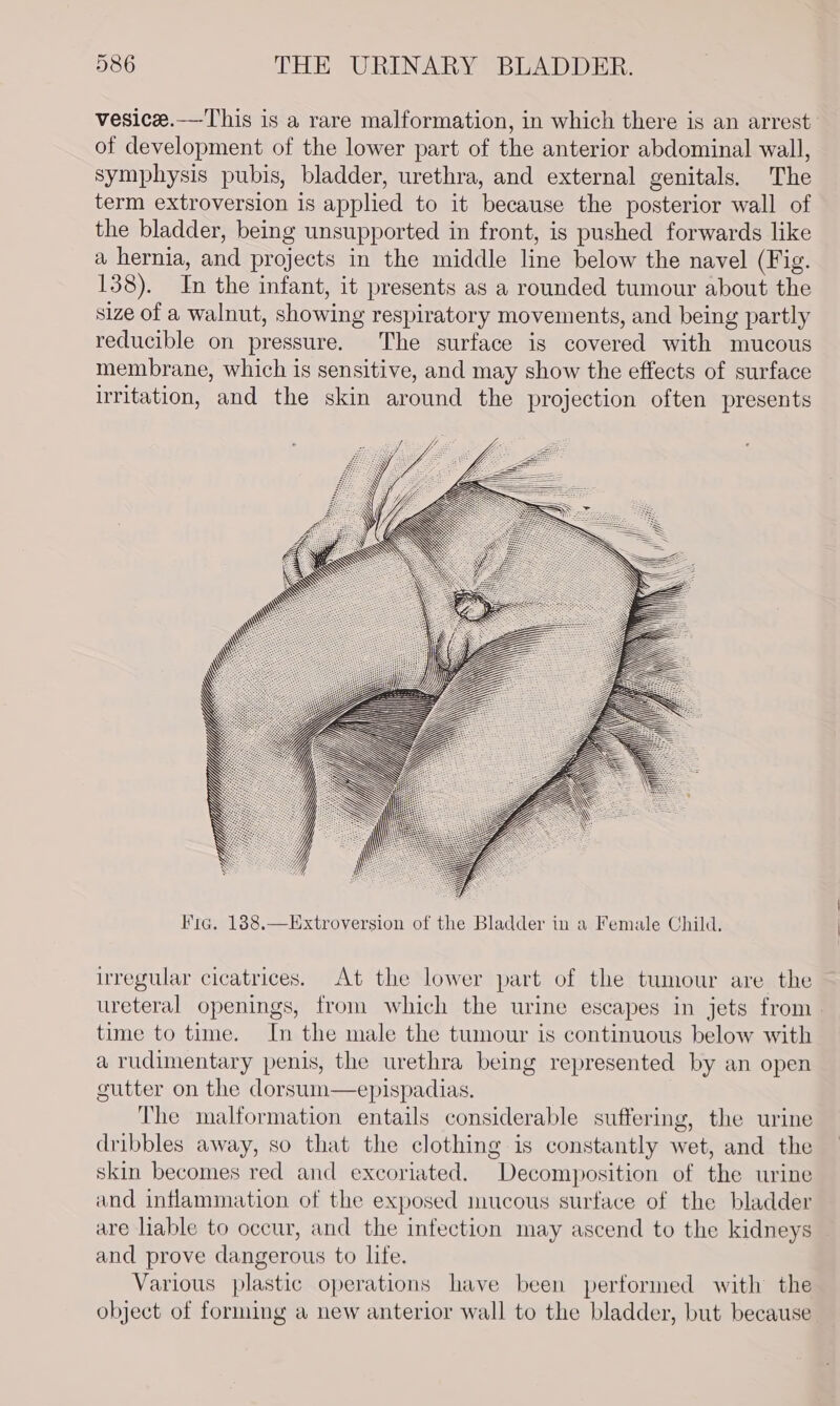 vesice.—-This is a rare malformation, in which there is an arrest of development of the lower part of the anterior abdominal wall, symphysis pubis, bladder, urethra, and external genitals. The term extroversion is applied to it because the posterior wall of the bladder, being unsupported in front, is pushed forwards like a hernia, and projects in the middle line below the navel (Fig. 138). In the infant, it presents as a rounded tumour about the size of a walnut, showing respiratory movements, and being partly reducible on pressure. The surface is covered with mucous membrane, which is sensitive, and may show the effects of surface irritation, and the skin around the projection often presents Fig. 188.—Extroversion of the Bladder in a Female Child, irregular cicatrices. At the lower part of the tumour are the ureteral openings, from which the urine escapes in jets from time to time. In the male the tumour is continuous below with a rudimentary penis, the urethra being represented by an open gutter on the dorsum—epispadias. The malformation entails considerable suffering, the urine dribbles away, so that the clothing is constantly wet, and the skin becomes red and excoriated. Decomposition of the urine and inflammation of the exposed mucous surface of the bladder are liable to occur, and the infection may ascend to the kidneys and prove dangerous to life. Various plastic operations have been performed with the object of forming a new anterior wall to the bladder, but because