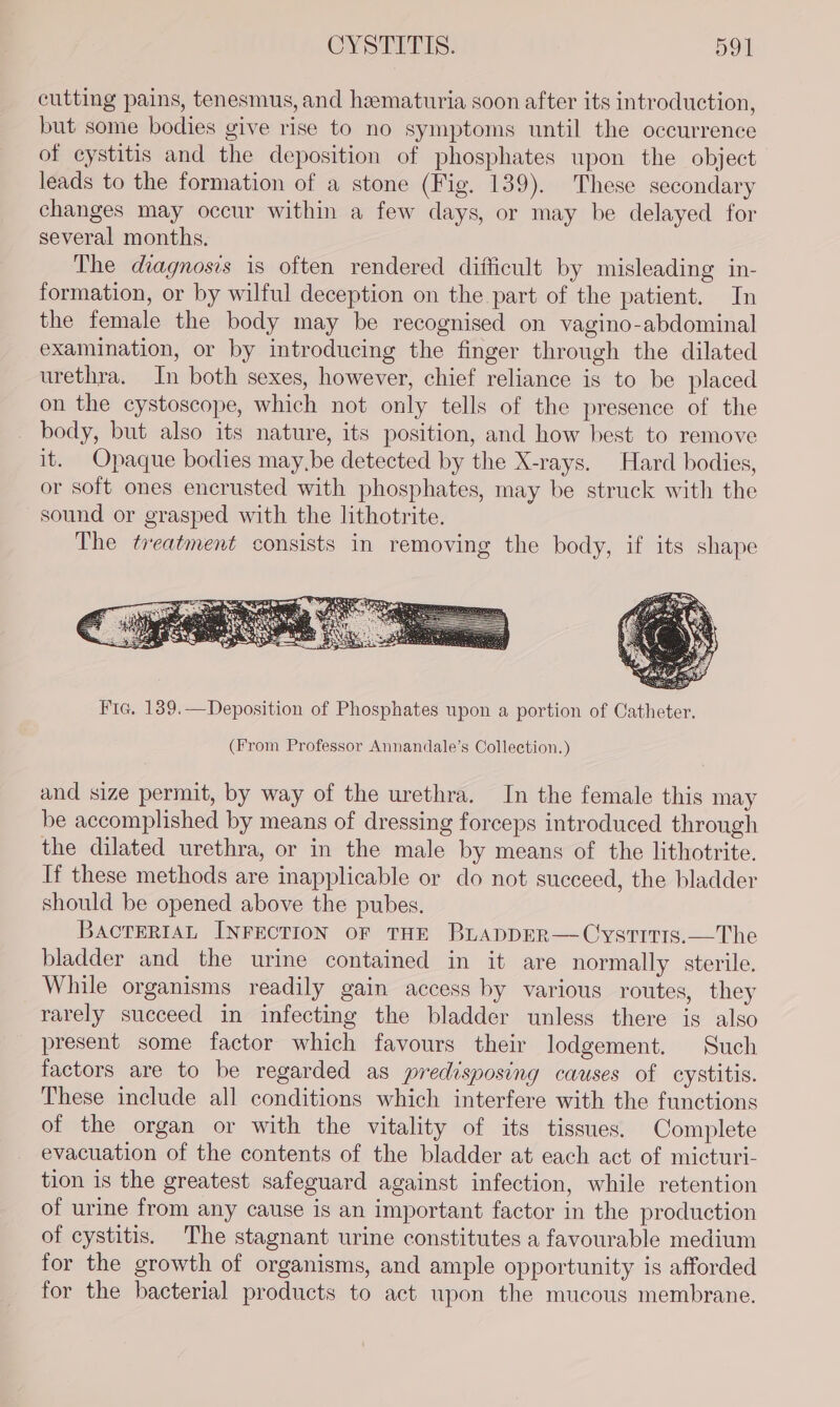 cutting pains, tenesmus, and hematuria soon after its introduction, but some bodies give rise to no symptoms until the occurrence of cystitis and the deposition of phosphates upon the object leads to the formation of a stone (Fig. 139). These secondary changes may occur within a few days, or may be delayed for several months. The diagnosis is often rendered difficult by misleading in- formation, or by wilful deception on the part of the patient. In the female the body may be recognised on vagino-abdominal examination, or by introducing the finger through the dilated urethra. In both sexes, however, chief reliance is to be placed on the cystoscope, which not only tells of the presence of the body, but also its nature, its position, and how best to remove it. Opaque bodies may,be detected by the X-rays. Hard bodies, or soft ones encrusted with phosphates, may be struck with the sound or grasped with the lithotrite. The treatment consists in removing the body, if its shape Fie. 189.—Deposition of Phosphates upon a portion of Catheter. (From Professor Annandale’s Collection.) and size permit, by way of the urethra. In the female this may be accomplished by means of dressing forceps introduced through the dilated urethra, or in the male by means of the lithotrite. If these methods are inapplicable or do not succeed, the bladder should be opened above the pubes. BACTERIAL INFECTION OF THE BLADDER—CystITIs.—The bladder and the urine contained in it are normally sterile. While organisms readily gain access by various routes, they rarely succeed in infecting the bladder unless there is also present some factor which favours their lodgement. Such factors are to be regarded as predisposing causes of cystitis. These include all conditions which interfere with the functions of the organ or with the vitality of its tissues. Complete evacuation of the contents of the bladder at each act of micturi- tion is the greatest safeguard against infection, while retention of urine from any cause is an important factor in the production of cystitis. The stagnant urine constitutes a favourable medium for the growth of organisms, and ample opportunity is afforded for the bacterial products to act upon the mucous membrane.