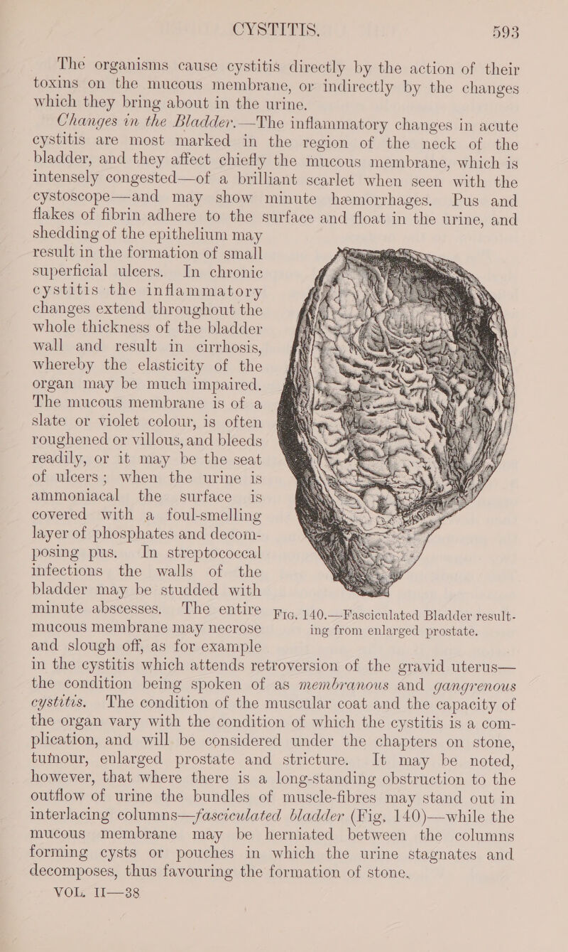 _ The organisms cause cystitis directly by the action of their toxins on the mucous membrane, or indirectly by the changes which they bring about in the urine. Changes in the Bladder.—The inflammatory changes in acute cystitis are most marked in the region of the neck of the bladder, and they affect chiefly the mucous membrane, which is intensely congested—of a brilliant scarlet when seen with the cystoscope—and may show minute hemorrhages. Pus and flakes of fibrin adhere to the surface and float in the urine, and shedding of the epithelium may | result in the formation of small superficial ulcers. In chronic cystitis the inflammatory changes extend throughout the whole thickness of the bladder wall and result in cirrhosis, whereby the elasticity of the organ may be much impaired. The mucous membrane is of a slate or violet colour, is often roughened or villous, and bleeds readily, or it may be the seat of ulcers; when the urine is ammoniacal the surface is covered with a foul-smelling layer of phosphates and decom- posing pus. In streptococcal infections the walls of the bladder may be studded with minute abscesses. The entire Fta. 140.—Fasciculated Bladder result- mucous membrane may necrose ing from enlarged prostate. and slough off, as for example in the cystitis which attends retroversion of the gravid uterus— the condition being spoken of as membranous and gangrenous cystitis. The condition of the muscular coat and the capacity of the organ vary with the condition of which the cystitis is a com- plication, and will be considered under the chapters on stone, tumour, enlarged prostate and stricture. It may be noted, however, that where there is a long-standing obstruction to the outflow of urine the bundles of muscle-fibres may stand out in interlacing columns—faseiculated bladder (Fig, 140)—while the mucous membrane may be herniated between the columns forming cysts or pouches in which the urine stagnates and decomposes, thus favouring the formation of stone, VOL, 1I1—38