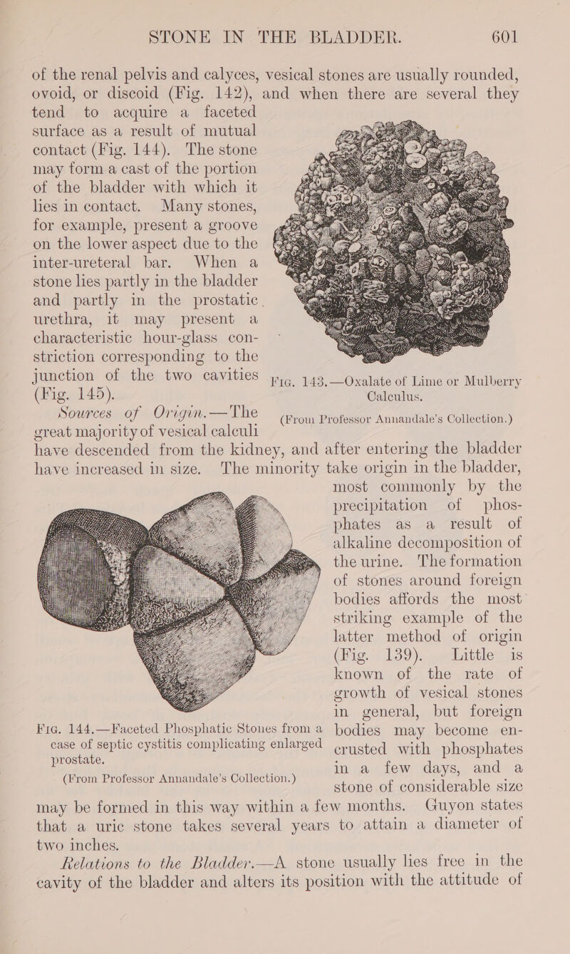 of the renal pelvis and calyces, vesical stones are usually rounded, ovoid, or discoid (Fig. 142), and when there are several they tend to acquire a faceted surface as a result of mutual contact (Fig. 144). The stone may form a cast of the portion of the bladder with which it hes in contact. Many stones, for example, present a groove on the lower aspect due to the inter-ureteral bar. When a stone lies partly in the bladder and partly in the prostatic. urethra, it may present a characteristic hour-glass con- striction corresponding to the Junction of the two cavities Fig. 143.—Oxalate of Lime or Mulberry (Fig. 145). Calculus. Sources of Origin. —The great majority of vesical calculi have descended from the kidney, and after entering the bladder have increased in size. The minority take origin in the bladder, most commonly by the precipitation of phos- phates as a result of alkaline decomposition of the urine. The formation of stones around foreign bodies affords the most striking example of the latter method of origin (ite 139). eeuattles! is known of the rate of growth of vesical stones in general, but foreign Pia. 144.—Faceted Phosphatic Stones from 2 bodies may become en- es ie haa cystitis complicating enlarged Grysted with phosphates ; in a few days, and a stone of considerable size imay be formed in this way within a few months. Guyon states that a uric stone takes several years to attain a diameter of two inches. Relations to the Bladder.—A stone usually lies free in the cavity of the bladder and alters its position with the attitude of (From Professor Annandale’s Collection. ) (From Professor Annandale’s Collection.)