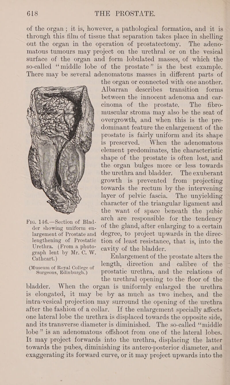 of the organ ; it is, however, a pathological formation, and it is through this film of tissue that separation takes place in shelling out the organ in the operation of prostatectomy. The adeno- matous tumours may project on the urethral or on the vesical surface of the organ and form lobulated masses, of which the so-called ‘middle lobe of the prostate” is the best example. There may be several adenomatous masses in different parts of the organ or connected with one another. Albarran describes transition forms between the innocent adenoma and car- cinoma of the prostate. The fibro- muscular stroma may also be the seat of overgrowth, and when this is the pre- dominant feature the enlargement of the prostate is fairly uniform and its shape is preserved. When the adenomatous element predominates, the characteristic shape of the prostate is often lost, and the organ bulges more or less towards the urethra and bladder. The exuberant growth is prevented from projecting towards the rectum by the intervening layer of pelvic fascia. The unyielding character of the triangular ligament and the want of space beneath the pubic FEELS Et pas ee ey APE arch are responsible for the tendency der showing uniform en- Of the gland, after enlarging to a certain largement of Prostate and degree, to project upwards in the direc- lengthening of Prostatic tion of least resistance, that is, into the Urethra. (From a photo- cavity of the bladder aph lent by Mr. Cc. W. Catheart.) i Enlargement of the prostate alters the . length, direction and calibre of the (Museum of Royal College of eas : Surgeons, Edinburgh.) prostatic urethra, and the relations of — the urethral opening to the floor of the bladder. When the organ is uniformly enlarged the urethra is elongated, it may be by as much as two inches, and the intra-vesical projection may surround the opening of the urethra after the fashion of a collar. If the enlargement specially affects one lateral lobe the urethra is displaced towards the opposite side, and its transverse diameter is diminished. The so-called “middle lobe” is an adenomatous offshoot from one of the lateral lobes. It may project forwards into the urethra, displacing the latter towards the pubes, diminishing its antero-posterior diameter, and exaggerating its forward curve, or it may project upwards into the