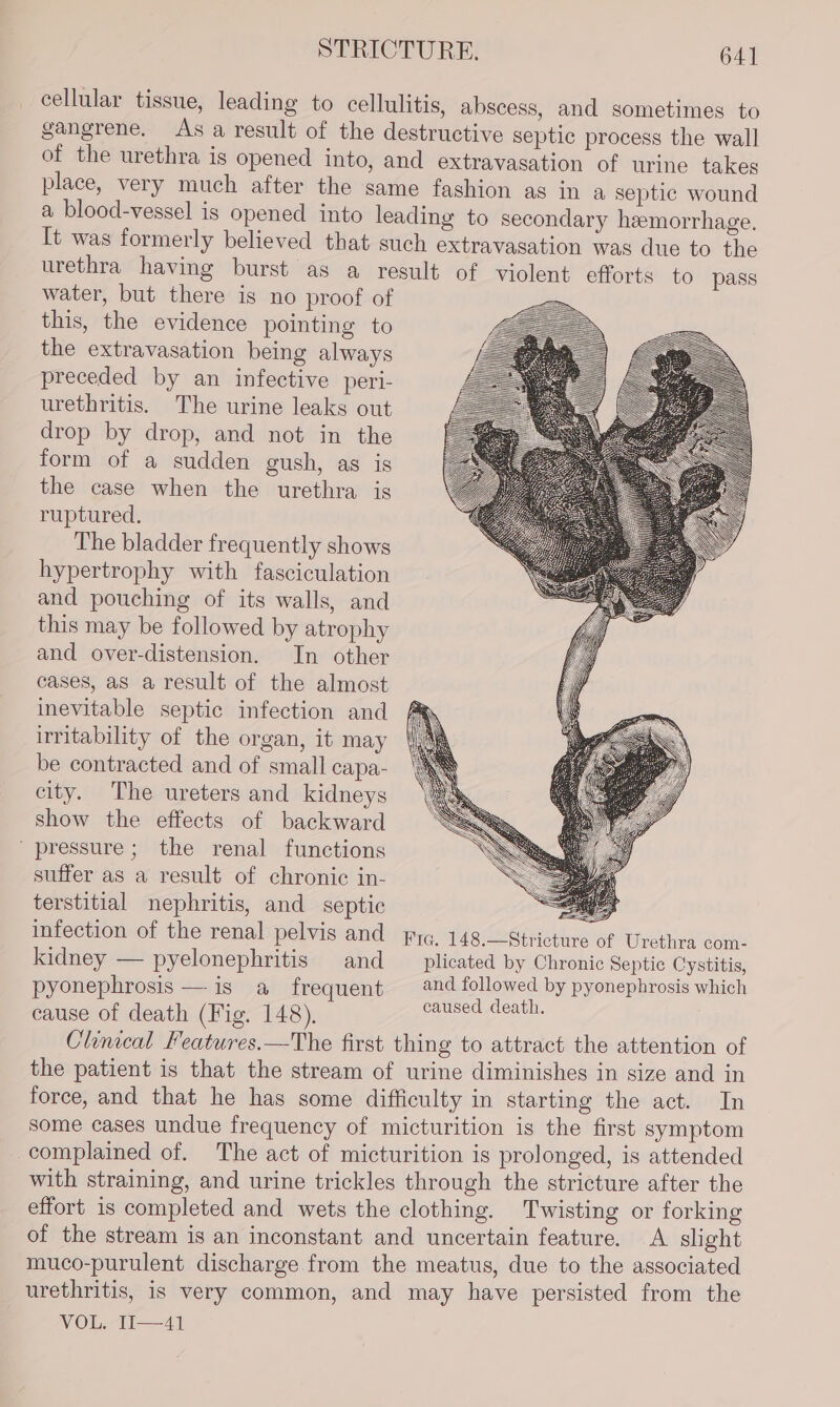 cellular tissue, leading to cellulitis, abscess, and sometimes to gangrene. As a result of the destructive septic process the wall of the urethra is opened into, and extravasation of urine takes place, very much after the same fashion as in a septic wound a blood-vessel is opened into leading to secondary hemorrhage. It was formerly believed that such extravasation was due to the urethra having burst as a result of violent efforts to pass water, but there is no proof of this, the evidence pointing to the extravasation being always preceded by an infective peri- urethritis. The urine leaks out drop by drop, and not in the form of a sudden gush, as is the case when the urethra is ruptured, The bladder frequently shows hypertrophy with fasciculation and pouching of its walls, and this may be followed by atrophy and over-distension. In other cases, as a result of the almost inevitable septic infection and irritability of the organ, it may be contracted and of small capa- city. The ureters and kidneys show the effects of backward pressure; the renal functions suffer as a result of chronic in- terstitial nephritis, and septic infection of the renal pelvis and pra, 148.—Stricture of Urethra com- kidney — pyelonephritis and __ plicated by Chronic Septic Cystitis, pyonephrosis — igs a frequent and followed by pyonephrosis which cause of death (Fig. 148), Sa Clinical Features.—The first thing to attract the attention of the patient is that the stream of urine diminishes in size and in force, and that he has some difficulty in starting the act. In some cases undue frequency of micturition is the first symptom complained of. The act of micturition is prolonged, is attended with straining, and urine trickles through the stricture after the effort is completed and wets the clothing. Twisting or forking of the stream is an inconstant and uncertain feature. A slight muco-purulent discharge from the meatus, due to the associated urethritis, is very common, and may have persisted from the VOL. -11—4]