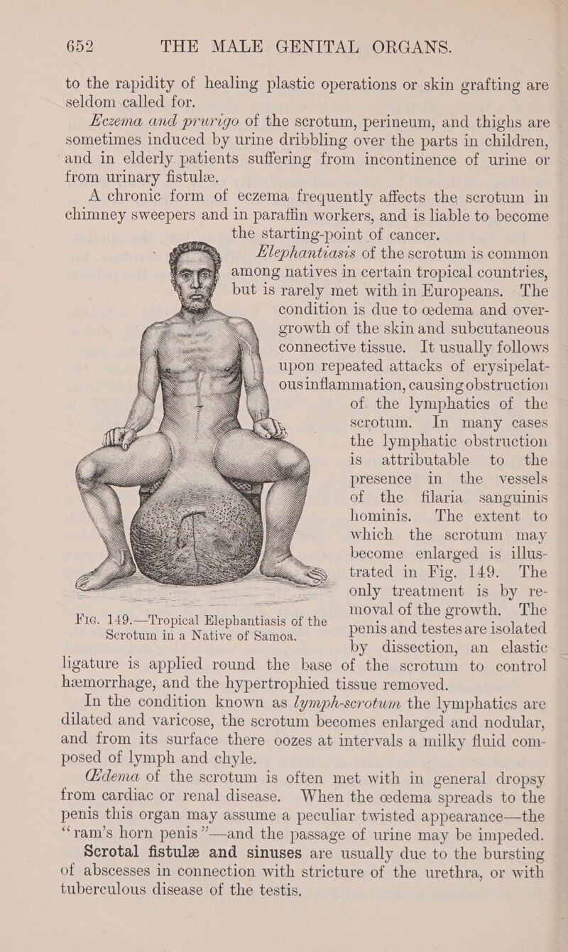 to the rapidity of healing plastic operations or skin grafting are seldom called for. Eczema and prurigo of the scrotum, perineum, and thighs are sometimes induced by urine dribbling over the parts in children, and in elderly patients suffering from incontinence of urine or from urinary fistulee. A chronic form of eczema frequently affects the scrotum in chimney sweepers and in paraftin workers, and is liable to become the starting-point of cancer. Hlephantiasis of the scrotum is common among natives in certain tropical countries, but is rarely met with in Europeans. The condition is due to cedema and over- growth of the skin and subcutaneous connective tissue. It usually follows upon repeated attacks of erysipelat- ousinflammation, causing obstruction of the lymphatics of the scrotum. In many cases the lymphatic obstruction is attributable to the presence in the _ vessels of the filaria sanguinis hominis. The extent to which the scrotum may Um become enlarged is illus- yy trated in Fig. 149. The 3 only treatment is by re- moval of the growth. The penis and testes are isolated by dissection, an elastic ligature is applied round the base of the scrotum to control hzmorrhage, and the hypertrophied tissue removed. In the condition known as lymph-scrotwm the lymphatics are dilated and varicose, the scrotum becomes enlarged and nodular, and from its surface there oozes at intervals a milky fluid com- posed of lymph and chyle. Gdema of the scrotum is often met with in general dropsy from cardiac or renal disease. When the cedema spreads to the penis this organ may assume a peculiar twisted appearance—the “ram’s horn penis ”—and the passage of urine may be impeded. Scrotal fistule and sinuses are usually due to the bursting of abscesses in connection with stricture of the urethra, or with tuberculous disease of the testis. Scrotum ina Native of Samoa.