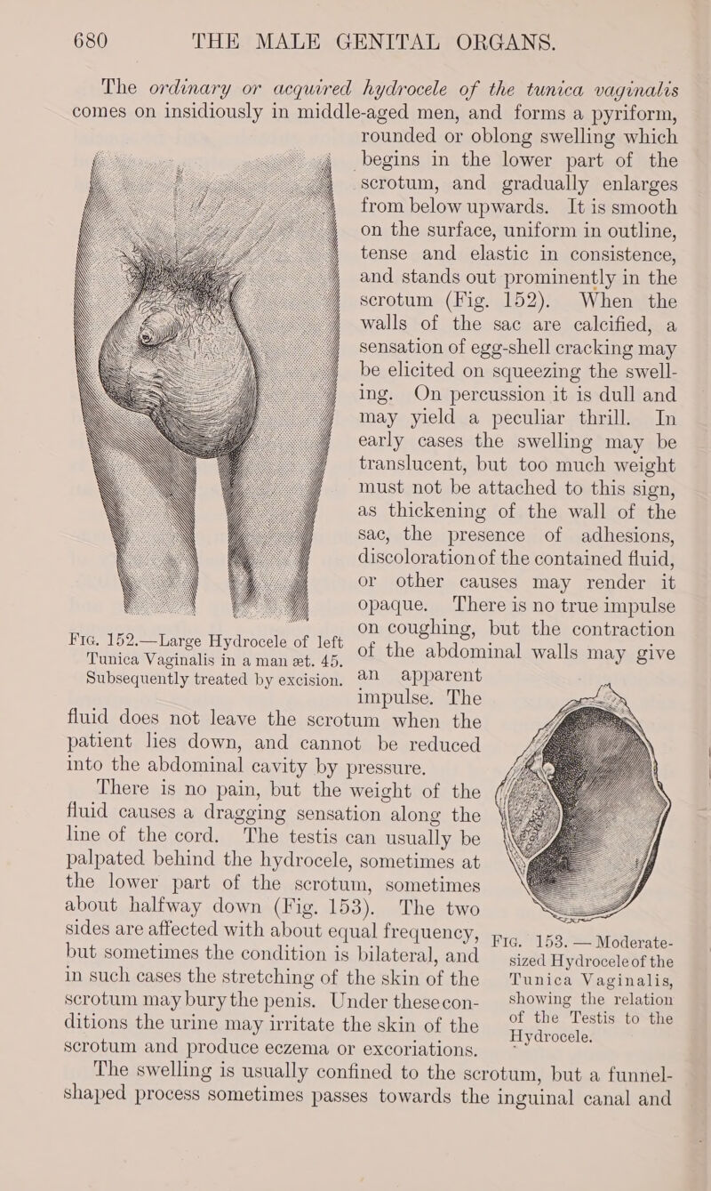 Fic. 152.—Large Hydrocele of left Tunica Vaginalis in a man et. 45. Subsequently treated by excision. rounded or oblong swelling which from below upwards. It is smooth on the surface, uniform in outline, tense and elastic in consistence, and stands out prominently in the scrotum (Fig. 152). When the walls of the sac are calcified, a sensation of egg-shell cracking may be elicited on squeezing the swell- ing. On percussion it is dull and may yield a peculiar thrill. In early cases the swelling may be translucent, but too much weight must not be attached to this sign, as thickening of the wall of the sac, the presence of adhesions, discoloration of the contained fluid, or other causes may render it opaque. There is no true impulse on coughing, but the contraction of the abdominal walls may give an apparent impulse. The fluid does not leave the scrotum when the patient lies down, and cannot be reduced into the abdominal cavity by pressure. There is no pain, but the weight of the fluid causes a dragging sensation along the line of the cord. The testis can usually be palpated behind the hydrocele, sometimes at the lower part of the scrotum, sometimes about halfway down (Fig. 153). The two sides are affected with about equal frequency, but sometimes the condition is bilateral, and in such cases the stretching of the skin of the scrotum may bury the penis. Under thesecon- ditions the urine may irritate the skin of the scrotum and produce eczema or excoriations. Fic. 153. — Moderate- sized Hydrocele of the Tunica Vaginalis, showing the relation of the Testis to the Hydrocele.