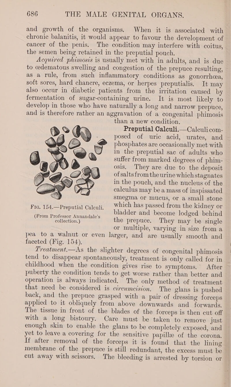 and growth of the organisms. When it is associated with chronic balanitis, it would appear to favour the development of cancer of the penis. The condition may interfere with coitus, the semen being retained in the preputial pouch. Acquired phimosis is usually met with in adults, and is due to cedematous swelling and congestion of the prepuce resulting, as a rule, from such inflammatory conditions as gonorrhcea, soft sores, hard chancre, eczema, or herpes preputialis. It may also occur in diabetic patients from the irritation caused by fermentation of sugar-containing urine. It is most likely to develop in those who have naturally a long and narrow prepuce, and is therefore rather an aggravation of a congenital phimosis than a new condition. Preputial Calculi.—Calculicom- posed of uric acid, urates, and phosphates are occasionally met with in the preputial sac of adults who suffer from marked degrees of phim- osis. They are due to the deposit of salts from the urine which stagnates in the pouch, and the nucleus of the calculus may be a mass of inspissated smegma or mucus, or a small stone iy Which has passed from the kidney or ite. gaiok “Besa ica igo bladder and become lodged behind (From Professor Annandale’s : collection.) the prepuce. They may be single or multiple, varying in size from a pea to a walnut or even larger, and are usually smooth and faceted (Fig. 154). Treatment.—As the slighter degrees of congenital phimosis tend to disappear spontaneously, treatment is only called for in childhood when the condition gives rise to symptoms. After puberty the condition tends to get worse rather than better and ~ operation is always indicated. The only method of treatment that need be considered is e¢reumcision. The glans is pushed back, and the prepuce grasped with a pair of dressing forceps applied to it obliquely from above downwards and forwards. The tissue in front of the blades of the forceps is then cut off with a long bistoury. Care must be taken to remove just enough skin to enable the glans to be completely exposed, and yet to leave a covering for the sensitive papillae of the corona. If after removal of the forceps it is found that the lining membrane of the prepuce is still redundant, the excess must be cut away with scissors. The bleeding is arrested by torsion or