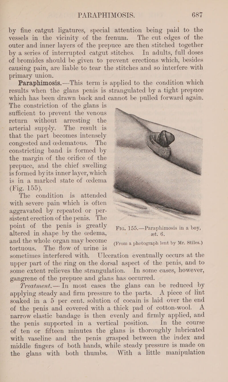 by fine catgut ligatures, special attention being paid to the vessels in the vicinity of the frenum. The cut edges of the outer and inner layers of the prepuce are then stitched together by a series of interrupted catgut stitches. In adults, full doses of bromides should be given to prevent erections which, besides causing pain, are liable to tear the stitches and so interfere with primary union. Paraphimosis.—This term is applied to the condition which results when the glans penis is strangulated by a tight prepuce which has been drawn back and cannot be pulled forward again. The constriction of the glans is sufficient to prevent the venous return without arresting the arterial supply. The result is that the part becomes intensely congested and cedematous. The constricting band is formed by the margin of the orifice of the prepuce, and the chief swelling is formed byits inner layer, which is in a marked state of ceedema (Fig. 155). The condition is attended with severe pain which is often ageravated by repeated or per- sistent erection of the penis. The point of the penis is greatly Fic. 155.—Paraphimosis in a boy, altered in shape by the cedema, matte: and the whole organ may become tortuous. The flow of urine is sometimes interfered with. Ulceration eventually occurs at the upper part of the ring on the dorsal aspect of the penis, and to some extent relieves the strangulation. In some cases, however, gangrene of the prepuce and glans has occurred. Treatment.— In most cases the glans can be reduced by applying steady and firm pressure to the parts. A piece of lint soaked in a 5 per cent. solution of cocain is laid over the end of the penis and covered with a thick pad of cotton-wool. A ~ narrow elastic bandage is then evenly and firmly applied, and the penis supported in a vertical position. In the course of ten or fifteen minutes the glans is thoroughly lubricated with vaseline and the penis grasped between the index and middle fingers of both hands, while steady pressure 1s made on the glans with both thumbs. With a little manipulation (From a photograph lent by Mr. Stiles.)