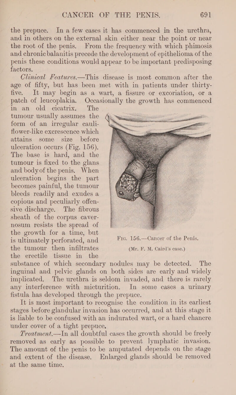 the prepuce. In a few cases it has commenced in the urethra, and in others on the external skin either near the point or near the root of the penis. From the frequency with which phimosis and chronic balanitis precede the development of epithelioma of the penis these conditions would appear to be important predisposing factors. Cluucal Peatuwres.—This disease is most common after the age of fifty, but has been met with in patients under thirty- five. It may begin as a wart, a fissure or excoriation, or a patch of leucoplakia. Occasionally the growth has commenced in an old cicatrix. The tumour usually assumes the form of an irregular cauli- flower-like excrescence which attains some size before ulceration occurs (Fig. 156). The base is hard, and the tumour is fixed to the glans and body of the penis. When ulceration begins the part becomes painful, the tumour bleeds readily and exudes a copious and peculiarly offen- sive discharge. The fibrous sheath of the corpus caver- nosum resists the spread of the growth for a time, but is ultimately perforated, and the tumour then infiltrates (Mr. F. M. Caird’s case.) the erectile tissue in the substance of which secondary nodules may be detected. The inguinal and pelvic glands on both sides are early and widely implicated. The urethra is seldom invaded, and there is rarely any interference with micturition. In some cases a urinary fistula has developed through the prepuce. It is most important to recognise the condition in its earliest stages before glandular invasion has occurred, and at this stage it is liable to be confused with an indurated wart, or a hard chancre under cover of a tight prepuce. Treatment.—In all doubtful cases the growth should be freely removed as early as possible to prevent lymphatic invasion. The amount of the penis to be amputated depends on the stage and extent of the disease. Enlarged glands should be removed at the same time.