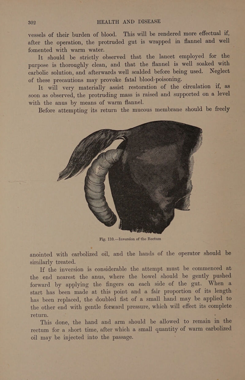vessels of their burden of blood. This will be rendered more effectual if, after the operation, the protruded gut is wrapped in flannel and well fomented with warm water. It should be strictly observed that the lancet employed for the purpose is thoroughly clean, and that the flannel is well soaked with carbolic solution, and afterwards well scalded before being used. Neglect of these precautions may provoke fatal blood-poisoning. It will very materially assist restoration of the circulation if, as soon as observed, the protruding mass is raised and supported on a level with the anus by means of warm flannel. | Before attempting its return the mucous membrane should be freely anointed with carbolized oil, and the hands of the operator should be similarly treated. If the inversion is considerable the attempt must be commenced at the end nearest the anus, where the bowel should be gently pushed forward by applying the fingers on each side of the gut. When a start has been made at this point and a fair proportion of its length ~ has been replaced, the doubled fist of a small hand may be applied to the other end with gentle forward pressure, which will effect its complete return. ° This done, the hand and arm should be allowed to remain in the rectum for a short time, after which a small quantity of warm carbolized oil may be injected into the passage. |