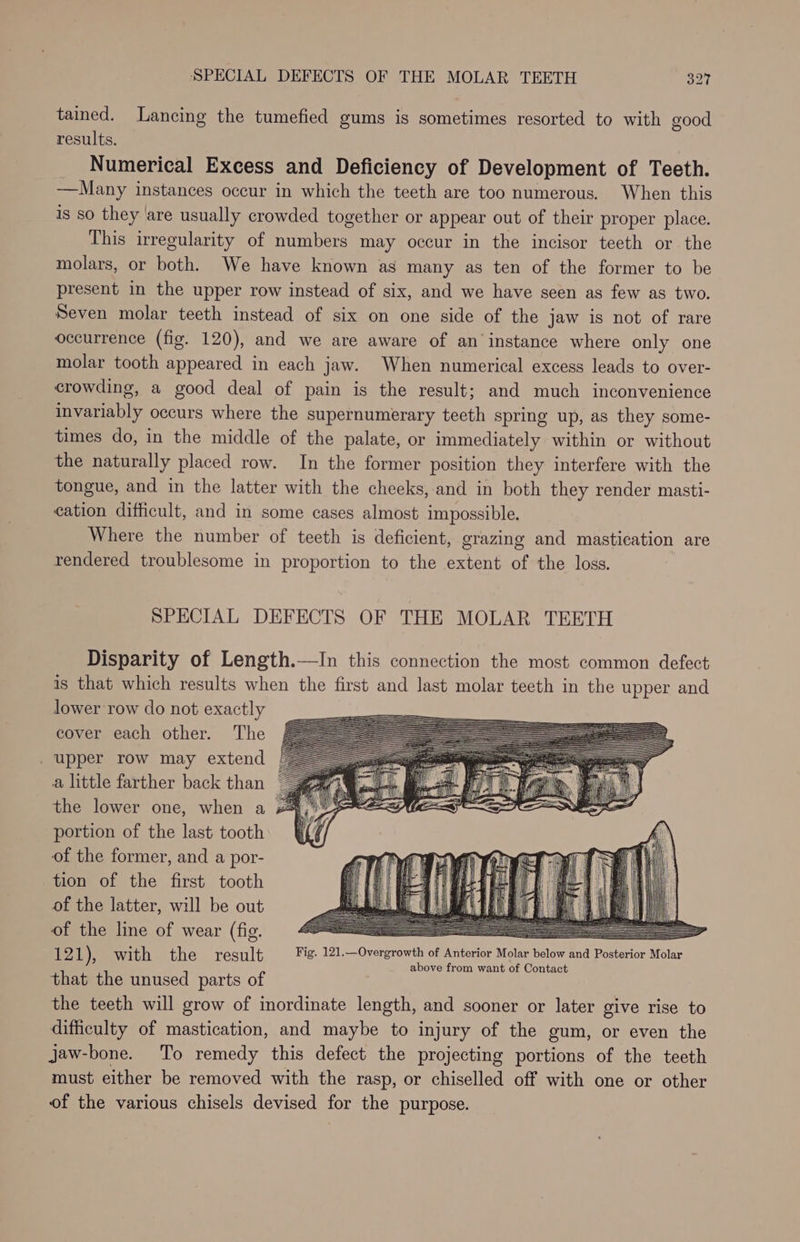 tained. Lancing the tumefied gums is sometimes resorted to with good results. Numerical Excess and Deficiency of Development of Teeth. —Many instances occur in which the teeth are too numerous. When this is so they ‘are usually crowded together or appear out of their proper place. This irregularity of numbers may occur in the incisor teeth or the molars, or both. We have known as many as ten of the former to be present in the upper row instead of six, and we have seen as few as two. Seven molar teeth instead of six on one side of the jaw is not of rare occurrence (fig. 120), and we are aware of an instance where only one molar tooth appeared in each jaw. When numerical excess leads to over- crowding, a good deal of pain is the result; and much inconvenience invariably occurs where the supernumerary teeth spring up, as they some- times do, in the middle of the palate, or immediately within or without the naturally placed row. In the former position they interfere with the tongue, and in the latter with the cheeks, and in both they render masti- cation difficult, and in some cases almost impossible. Where the number of teeth is deficient, grazing and mastication are rendered troublesome in proportion to the extent of the loss. SPECIAL DEFECTS OF THE MOLAR TEETH Disparity of Length.—In this connection the most common defect is that which results when the first and last molar teeth in the upper and lower row do not exactly cover each other. The _ upper row may extend a little farther back than the lower one, when a portion of the last tooth of the former, and a por- tion of the first tooth of the latter, will be out of the line of wear (fig. : a, 12 1) with the result Fig. 121.—Overgrowth of Anterior Molar below and Posterior Molar a above from want of Contact that the unused parts of the teeth will grow of inordinate length, and sooner or later give rise to difficulty of mastication, and maybe to injury of the gum, or even the jaw-bone. To remedy this defect the projecting portions of the teeth must either be removed with the rasp, or chiselled off with one or other of the various chisels devised for the purpose.