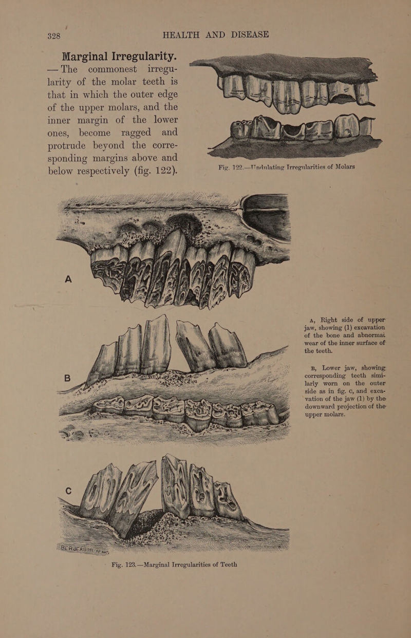 Marginal Irregularity. —The commonest irregu- larity of the molar teeth is that in which the outer edge of the upper molars, and the inner margin of the lower ones, become ragged and protrude beyond the corre- sponding margins above and below respectively (fig. 122). A, Right side of upper jaw, showing (1) excavation of the bone and abnormat wear of the inner surface of the teeth. B, Lower jaw, showing: corresponding teeth simi- larly worn on the outer side as in fig. 0, and exca- vation of the jaw (1) by the downward projection of the upper molars.