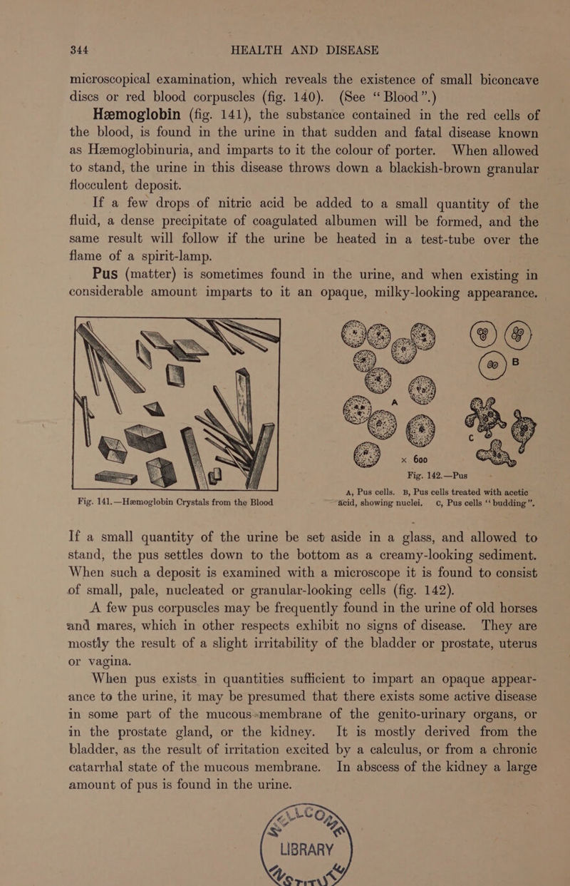 microscopical examination, which reveals the existence of small biconcave discs or red blood corpuscles (fig. 140). (See “ Blood”.) Hzemoglobin (fig. 141), the substance contained in the red cells of the blood, is found in the urine in that sudden and fatal disease known as Heemoglobinuria, and imparts to it the colour of porter. When allowed to stand, the urine in this disease throws down a blackish-brown granular flocculent deposit. If a few drops of nitric acid be added to a small quantity of the fluid, a dense precipitate of coagulated albumen will be formed, and the same result will follow if the urine be heated in a test-tube over the flame of a spirit-lamp. Pus (matter) is sometimes found in the urine, and when existing in considerable amount imparts to it an opaque, milky-looking appearance. A, Pus cells. 3B, Pus cells treated with acetic Fig. 141.—Hemoglobin Crystals from the Blood acid, showing nuclei. ©, Pus cells ‘‘ budding”. If a small quantity of the urine be set aside in a glass, and allowed to stand, the pus settles down to the bottom as a creamy-looking sediment. When such a deposit is examined with a microscope it is found to consist of small, pale, nucleated or granular-looking cells (fig. 142). A. few pus corpuscles may be frequently found in the urine of old horses and mares, which in other respects exhibit no signs of disease. They are mostly the result of a slight irritability of the bladder or prostate, uterus or vagina. When pus exists in quantities sufficient to impart an opaque appear- ance to the urine, it may be presumed that there exists some active disease in some part of the mucoussmembrane of the genito-urinary organs, or in the prostate gland, or the kidney. It is mostly derived from the bladder, as the result of irritation excited by a calculus, or from a chronic catarrhal state of the mucous membrane. In abscess of the kidney a large amount of pus is found in the urine. s om)? ‘Ss ~@ LIBRARY Vor