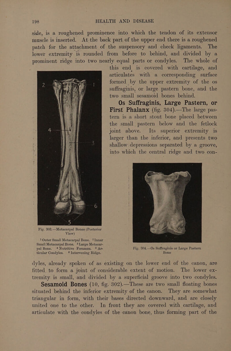 side, is a roughened prominence into which the tendon of its extensor muscle is inserted. At the back part of the upper end there is a roughened patch for the attachment of the suspensory and check ligaments. The lower extremity is rounded from before to behind, and divided by a prominent ridge into two nearly equal parts or condyles. The whole of this end is covered with cartilage, and articulates with a corresponding surface formed by the upper extremity of the os suffraginis, or large pastern bone, and the two small sesamoid bones behind. Os Suffraginis, Large Pastern, or First Phalanx (fig. 304).—The large pas- tern is a short stout bone placed between the small pastern below and the fetlock joint above. Its superior extremity is larger than the inferior, and presents two shallow depressions separated by a groove, into which the central ridge and two con- 1Quter Small Metacarpal Bone. * Inner Small Metacarpal Bone. # Large Metacar- pal Bone. 4 Nutritive Foramen. ®* Ar- Fig. 304.—Os Suffraginis or Large Pastern ticular Condyles. 6 Intervening Ridge. Bone dyles, already spoken of as existing on the lower end of the canon, are fitted. to form a joint of considerable extent of motion. The lower ex- tremity is small, and divided by a superficial groove into two condyles. Sesamoid Bones (10, fig. 302).—These are two small floating bones situated behind the inferior extremity of the canon. ‘They are somewhat triangular in form, with their bases directed downward, and are closely united one to the other. In front they are covered with cartilage, and articulate with the condyles of the canon bone, thus forming part of the