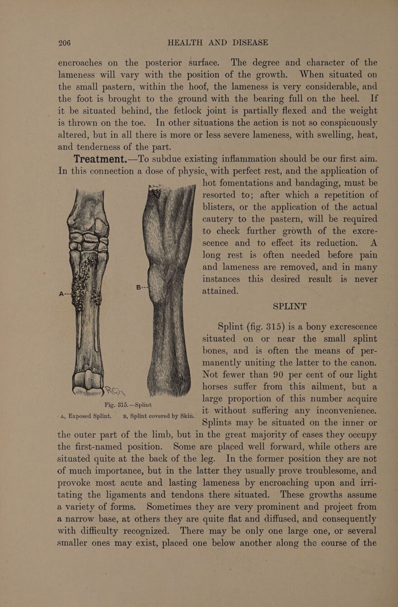 encroaches on the posterior surface. The degree and character of the lameness will vary with the position of the growth. When situated on the small pastern, within the hoof, the lameness is very considerable, and the foot is brought to the ground with the bearing full on the heel. If it be situated behind, the fetlock joint is partially flexed and the weight is thrown on the toe. In other situations the action is not so conspicuously altered, but in all there is more or less severe lameness, with swelling, heat, and tenderness of the part. Treatment.—To subdue existing inflammation should be our first aim. In this connection a dose of physic, with perfect rest, and the application of ay lot fomentations and bandaging, must be resorted to; after which a repetition of blisters, or the application of the actual cautery to the pastern, will be required to check further growth of the excre- scence and to effect its reduction. A long rest is often needed before pain and lameness are removed, and in many instances this desired result is never attained. SPLINT Splint (fig. 315) is a bony excrescence situated on or near the small splint bones, and is often the means of per- manently uniting the latter to the canon. Not fewer than 90 per cent of our light — horses suffer from this ailment, but a large proportion of this number acquire it without suffering any inconvenience. Splints may be situated on the inner or the outer part of the limb, but in the great majority of cases they occupy the first-named position. Some are placed well forward, while others are situated quite at the back of the leg. In the former position they are not of much importance, but in the latter they usually prove troublesome, and provoke most acute and lasting lameness by encroaching upon and irri- tating the ligaments and tendons there situated. These growths assume a variety of forms. Sometimes they are very prominent and project from a narrow base, at others they are quite flat and diffused, and consequently with difficulty recognized. There may be only one large one, or several smaller ones may exist, placed one below another along the course of the - A, Exposed Splint. B, Splint covered by Skin.