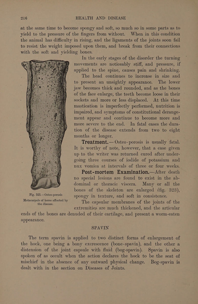 at the same time to become spongy and soft, so much so in some parts as to yield to the pressure of the fingers from without. When in this condition the animal has difficulty in rising, and the ligaments of the joints soon fail to resist the weight imposed upon them, and break from their connections with the soft and yielding bones. In the early stages of the disorder the turning movements are noticeably stiff, and pressure, if applied to the spine, causes pain and shrinking. The head continues to increase in size and to present an unsightly appearance. ‘The lower jaw becomes thick and rounded, and as the bones of the face enlarge, the teeth become loose in their sockets and more or less displaced. At this time mastication is imperfectly performed, nutrition is impaired, and symptoms of constitutional derange- ment appear and continue to become more and more severe to the end. In fatal cases the dura- tion of the disease extends from two to eight months or longer. Treatment. — Osteo-porosis is usually fatal. It is worthy of note, however, that a case given up to the writer was returned cured after under- going three courses of iodide of potassium and nux vomica at intervals of three or four weeks. Post-mortem Examination.—After death no special lesions are found to exist in the ab- dominal or thoracic viscera. Many or all the bones of the skeleton are enlarged (fig. 323), spongy in texture, and soft in consistence. The capsular membranes of the joints of the extremities are much thickened, and the articular ends of the bones are denuded of their cartilage, and present a worm-eaten appearance. Metacarpals of horse affected by the disease. SPAVIN The term spavin is applied to two distinct forms of enlargement of the hock, one being a bony excrescence (bone-spavin), and the other a distension of the joint capsule with fluid (bog-spavin). Spavin is also spoken of as occult when the action declares the hock to be the seat of mischief in the absence of any outward physical change. Bog-spavin is dealt with in the section on Diseases of Joints.