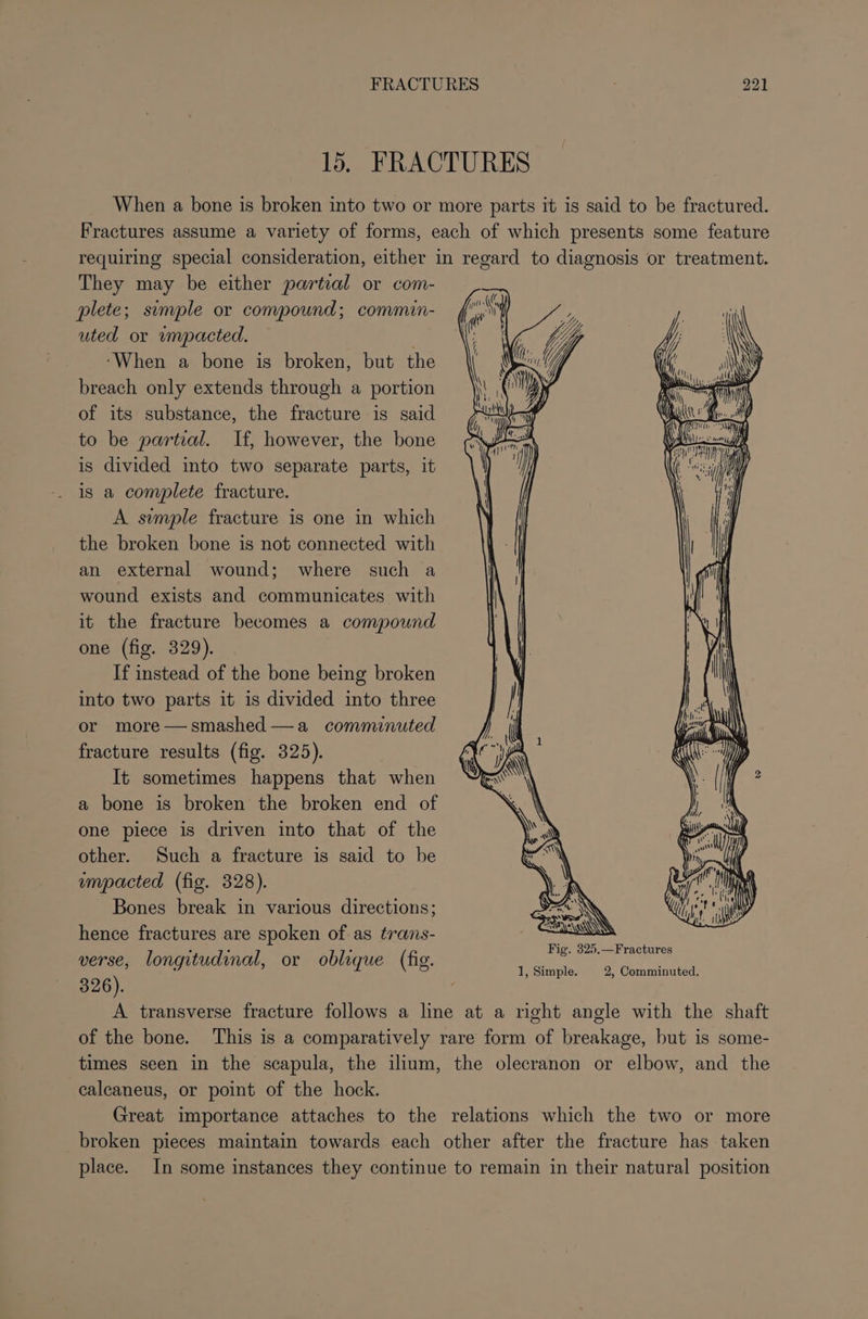 15. FRACTURES When a bone is broken into two or more parts it is said to be fractured. Fractures assume a variety of forms, each of which presents some feature requiring special consideration, either in regard to diagnosis or treatment. They may be either partial or com- plete; simple or compound; commin- uted or umpacted. ‘When a bone is broken, but the breach only extends through a portion of its substance, the fracture is said to be partial. If, however, the bone is divided into two separate parts, it is a complete fracture. A simple fracture is one in which the broken bone is not connected with an external wound; where such a wound exists and communicates with it the fracture becomes a compound one (fig. 329). If instead of the bone being broken into two parts it is divided into three or more—smashed—a commnuted fracture results (fig. 325). It sometimes happens that when a bone is broken the broken end of one piece is driven into that of the other. Such a fracture is said to be umpacted (fig. 328). Bones break in various directions; hence fractures are spoken of as trans- verse, longitudinal, or oblique (fig. 326). A transverse fracture follows a line at a right angle with the shaft of the bone. This is a comparatively rare form of breakage, but is some- times seen in the scapula, the ilium, the olecranon or elbow, and the calcaneus, or point of the hock. Great importance attaches to the relations which the two or more broken pieces maintain towards each other after the fracture has taken place. In some instances they continue to remain in their natural position 1, Simple. 2, Comminuted.