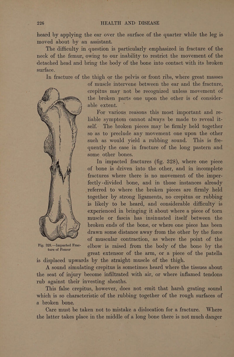 heard by applying the ear over the surface of the quarter while the leg is moved about by an assistant. The difficulty in question is particularly emphasized in fracture of the neck of the femur, owing to our inability to restrict the movement of the detached head and bring the body of the bone into contact with its broken surface. ? In fracture of the thigh or the pelvis or front ribs, where great masses of muscle intervene between the ear and the fracture, crepitus may not be recognized unless movement of the broken parts one upon the other is of consider- able extent. For various reasons this most important and re- liable symptom cannot always be made to reveal it- self. The broken pieces may be firmly held together so as to preclude any movement one upon the other such as would yield a rubbing sound. This is fre- quently the case in fracture of the long pastern and some other bones. In impacted fractures (fig. 328), where one piece of bone is driven into the other, and in incomplete fractures where there is no movement of the imper- fectly-divided bone, and in those instances already referred to where the broken pieces are firmly held together by strong ligaments, no crepitus or rubbing is likely to be heard, and considerable difficulty is experienced in bringing it about where a piece of torn muscle or fascia has insinuated itself between the broken ends of the bone, or where one piece has been drawn some distance away from the other by the force of muscular contraction, as where the point of the Mig, 388.~Impacted Frae- elbow is raised from the body of the bone by the great extensor of the arm, or a piece of the patella is displaced upwards by the straight muscle of the thigh. A sound simulating crepitus is sometimes heard where the tissues about the seat of injury become infiltrated with air, or where inflamed tendons rub against their investing sheaths. This false crepitus, however, does not emit that harsh grating sound which is so characteristic of the rubbing together of the rough surfaces of a broken bone. Care must be taken not to mistake a dislocation for a fracture. Where the latter takes place in the middle of a long bone there is not much danger
