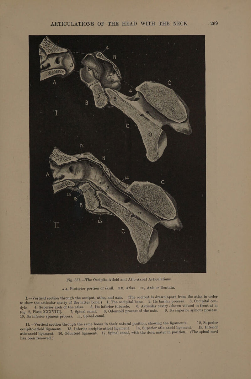 AA, Posterior portion of skull. BB, Atlas. cc, Axis or Dentata. 1.—Vertical section through the occiput, atlas, and axis. (The occiput is drawn apart from the atlas in order to show the articular cavity of the latter bone.) 1, The occipital bone. 2, Its basilar process. 3, Occipital con- dyle. 4, Superior arch of the atlas. 5, Its inferior tubercle. 6, Articular cavity (shown viewed in front at 3, Fig. 2, Plate XXXVIII). 7, Spinal canal. 8, Odontoid process of the axis. 9, Its superior spinous process. 10, Its inferior spinous process. 11, Spinal canal. II. Vertical section through the same bones in their natural position, showing the ligaments. 12, Superior occipito-atloid ligament. 13, Inferior occipito-atloid ligament. 14, Superior atlo-axoid ligament. 15, Inferior atlo-axoid ligament. 16, Odontoid ligament. 17, Spinal canal, with the dura mater in position. (The spinal cord has been removed.)