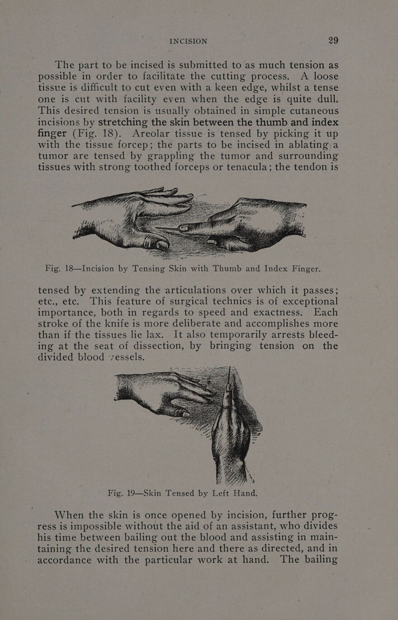 The part to be incised is submitted to as much tension as possible in order to facilitate the cutting process. A loose tissue is difficult to cut even with a keen edge, whilst a tense one is cut with facility even when the edge is quite dull. This desired tension is usually obtained in simple cutaneous incisions by stretching the skin between the thumb and index finger (Fig. 18). Areolar tissue is tensed by picking it up with the tissue forcep; the parts to be incised in ablating,a tumor are tensed by grappling the tumor and surrounding tissues with strong toothed forceps or tenacula; the tendon is Fig. 18—Incision by Tensing Skin with Thumb and Index Finger. tensed by extending the articulations over which it passes; etc., etc. This feature of surgical technics is of exceptional importance, both in regards to speed and exactness. Each stroke of the knife is more deliberate and accomplishes more than if the tissues lie lax. It also temporarily arrests bleed- ing at the seat of dissection, by bringing tension on the divided blood ‘vessels. Fig. 19—Skin Tensed by Left Hand. When the skin is once opened by incision, further prog- ress is impossible without the aid of an assistant, who divides his time between bailing out the blood and assisting in main- taining the desired tension here and there as directed, and in accordance with the particular work at hand. The bailing